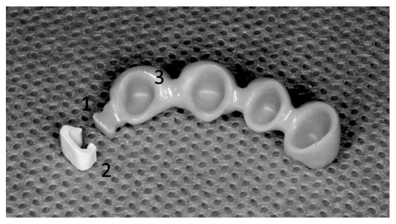 Bolt retention structure integrally formed with artificial crown and manufacturing method of matching bolt channel