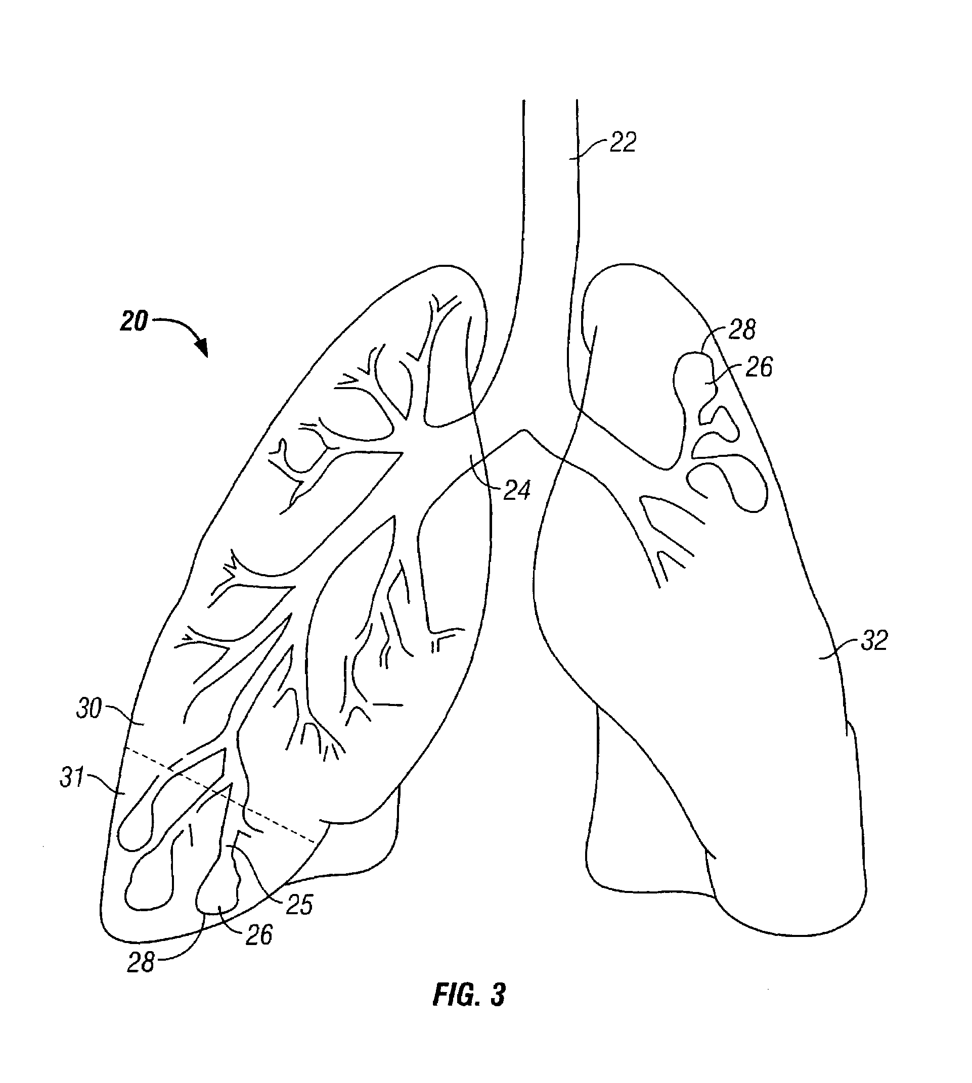 Method of increasing gas exchange of a lung