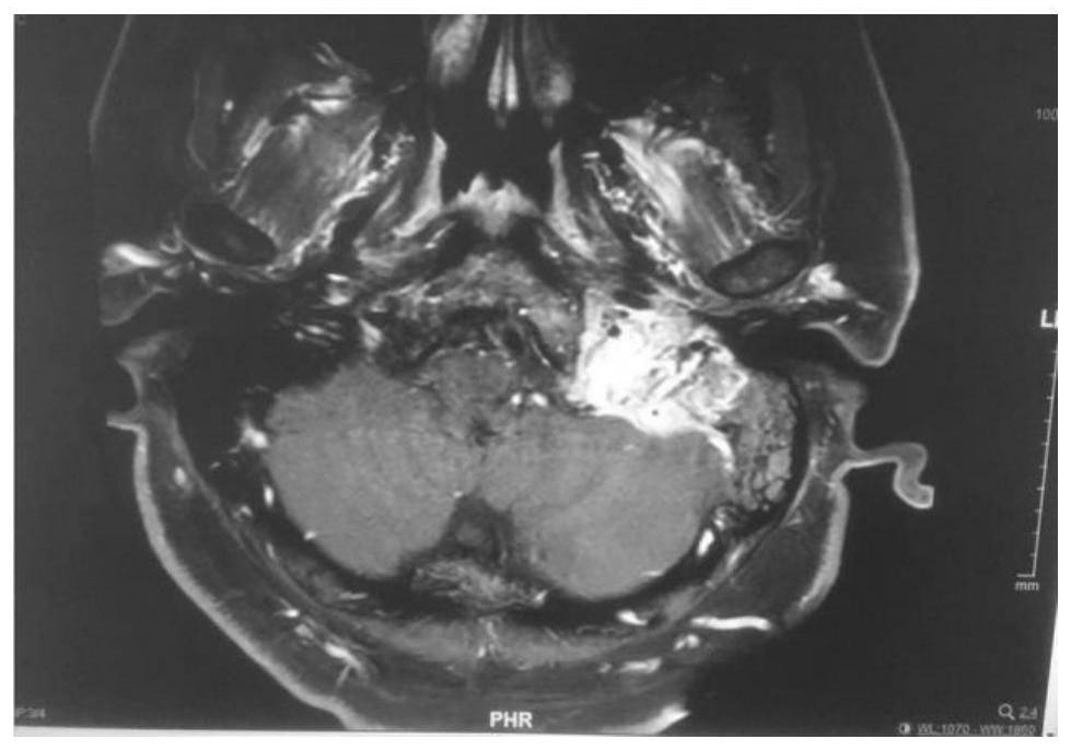 Immortalized cell line of human jugular paraganglioma and its application