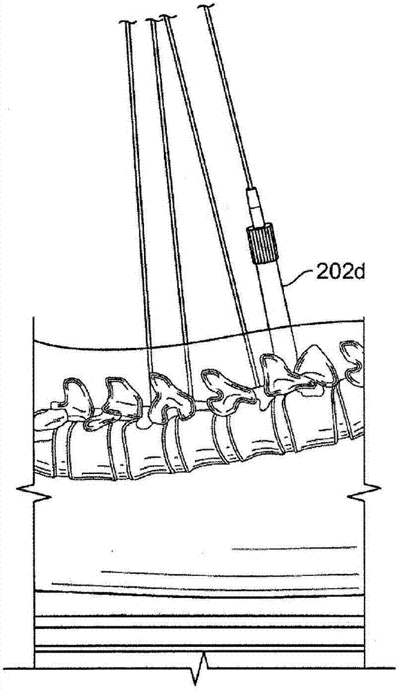 Systems and methods for performing minimally invasive surgery