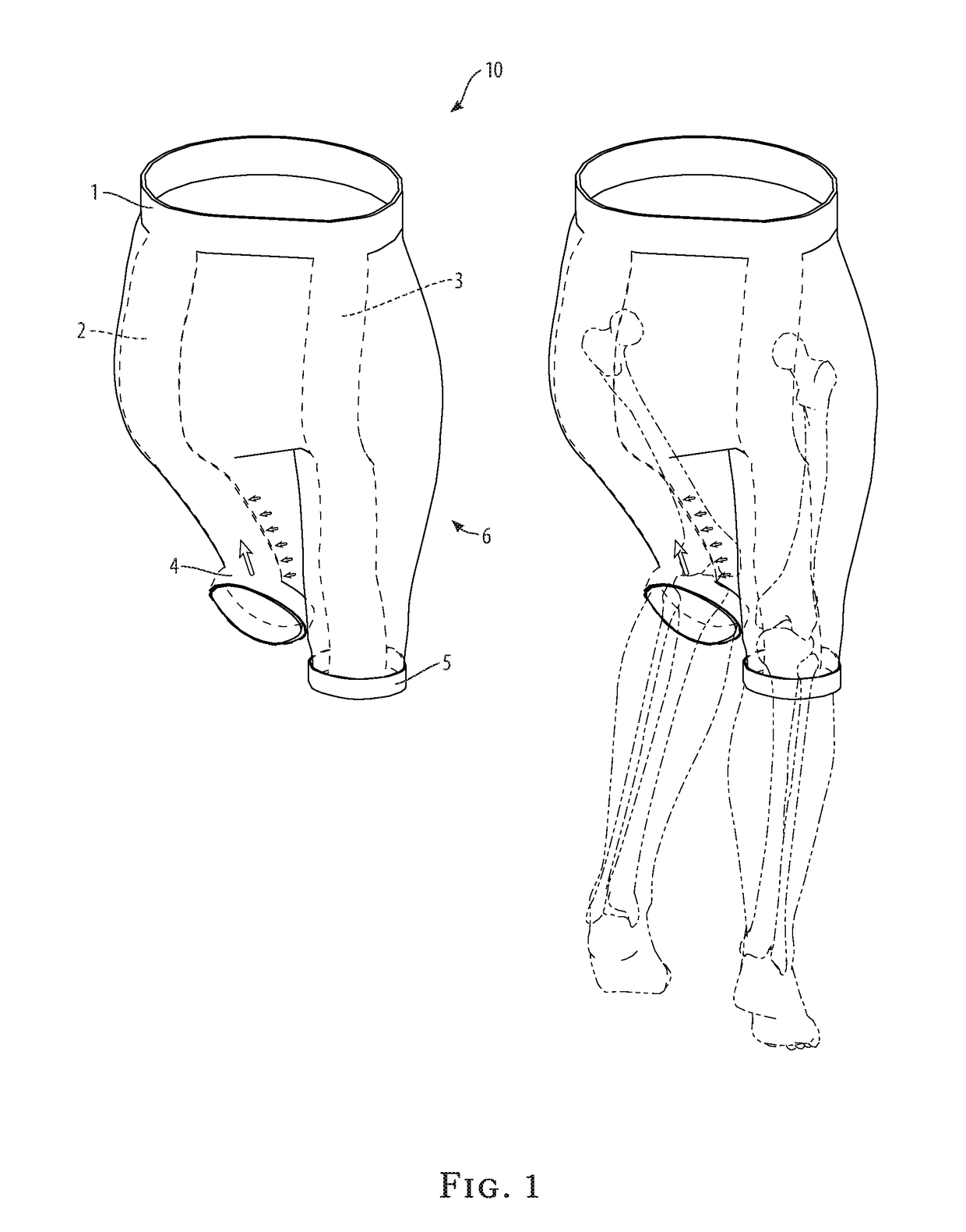 Knee-acl support breeches system and method