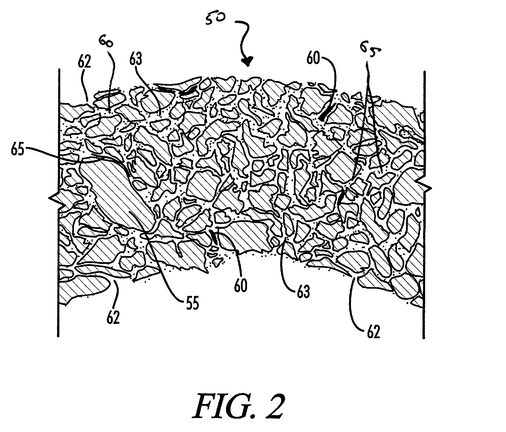 Method of forming a composite bone material implant