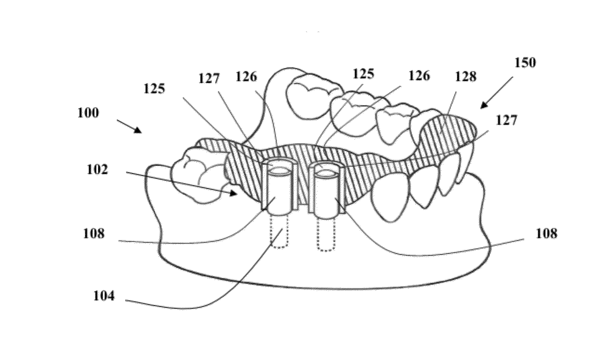 Method and apparatus for bending a guide post used in forming a template for locating a dental inplant hole