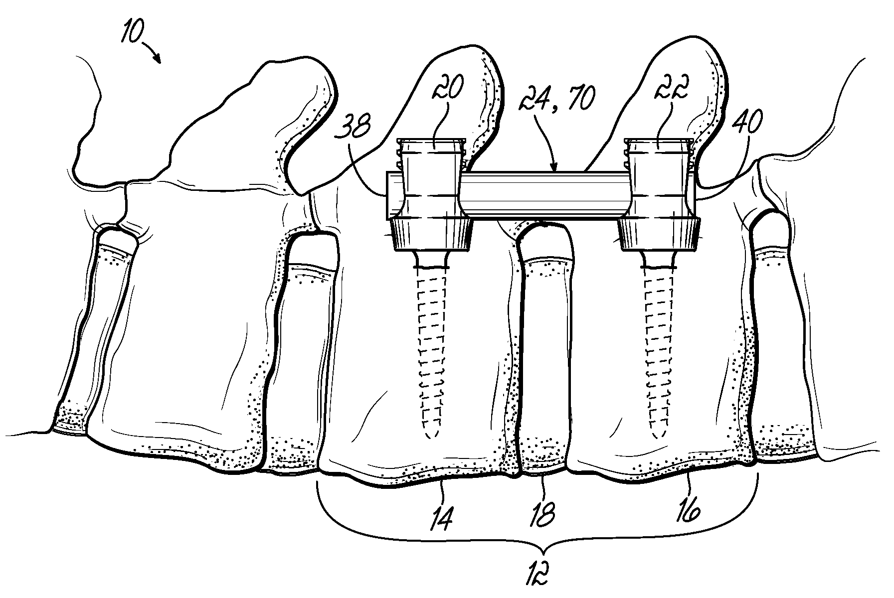 Flexible member for use in a spinal column and method for making