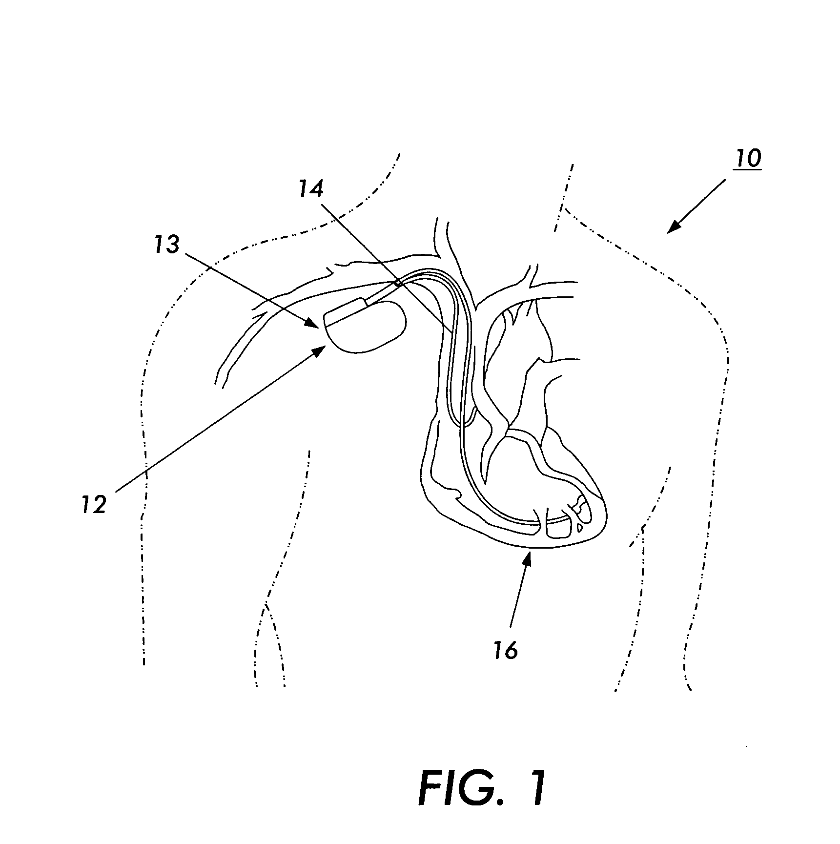 Device and method for preventing magnetic resonance imaging induced damage