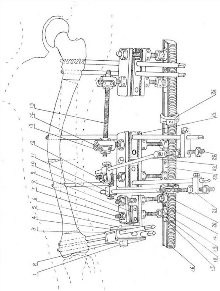 Mechanical dual-upper-limb dynamic comprehensive restoration of multi-segment bone deformity external fixation bracket