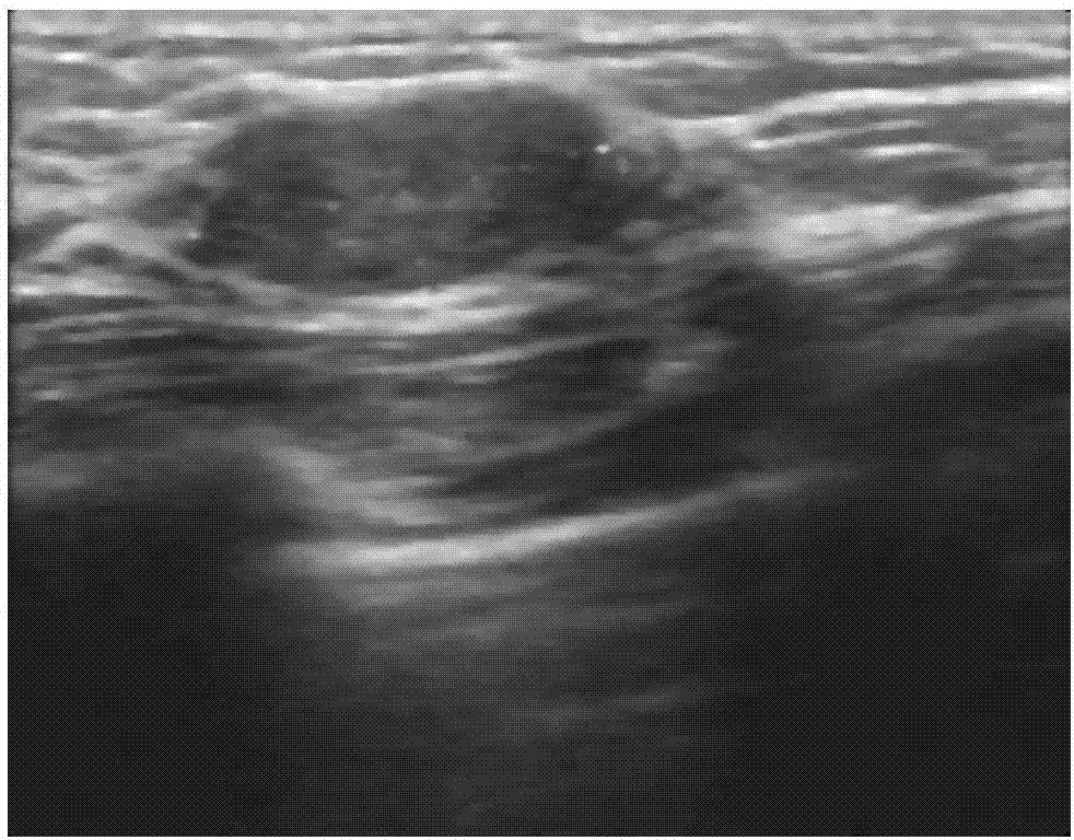 Breast tumor classification method and device based on ultrasound image feature correlation