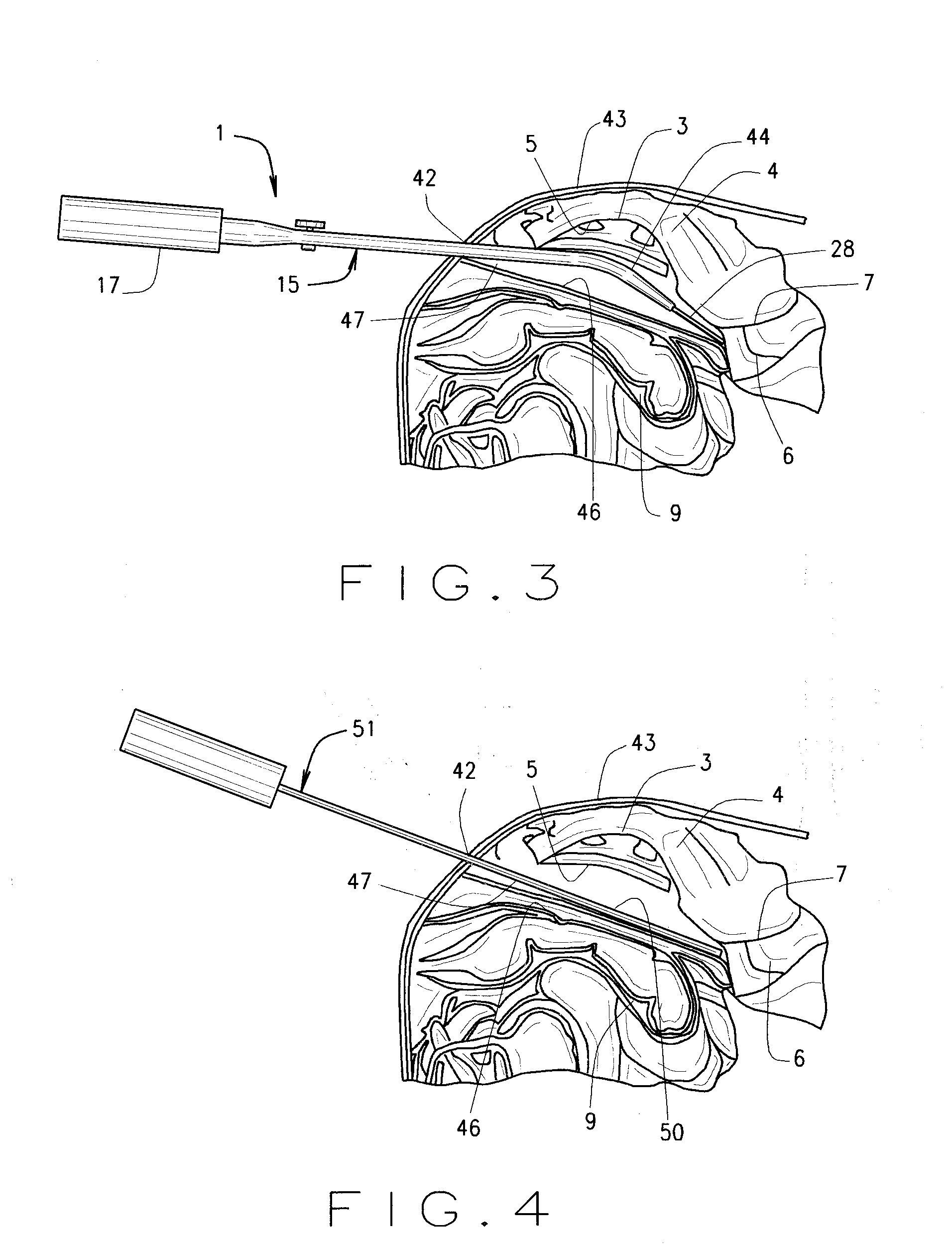 Surgical tool and method