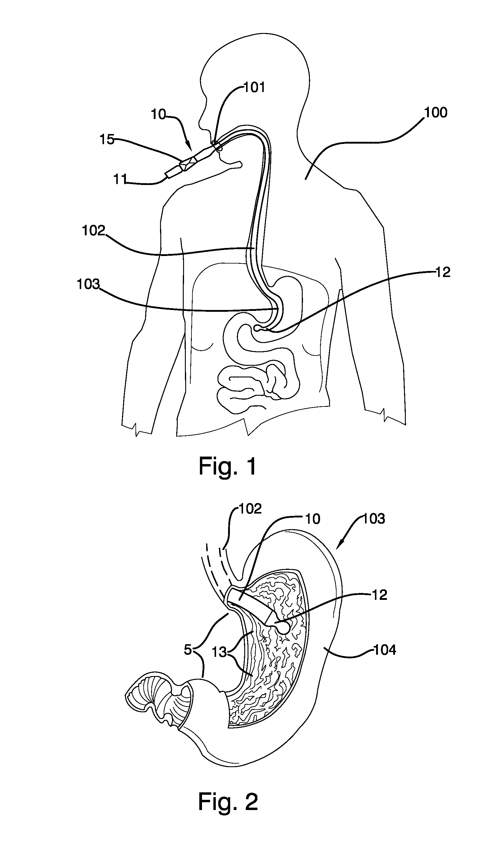 Mechanically-guided transoral bougie