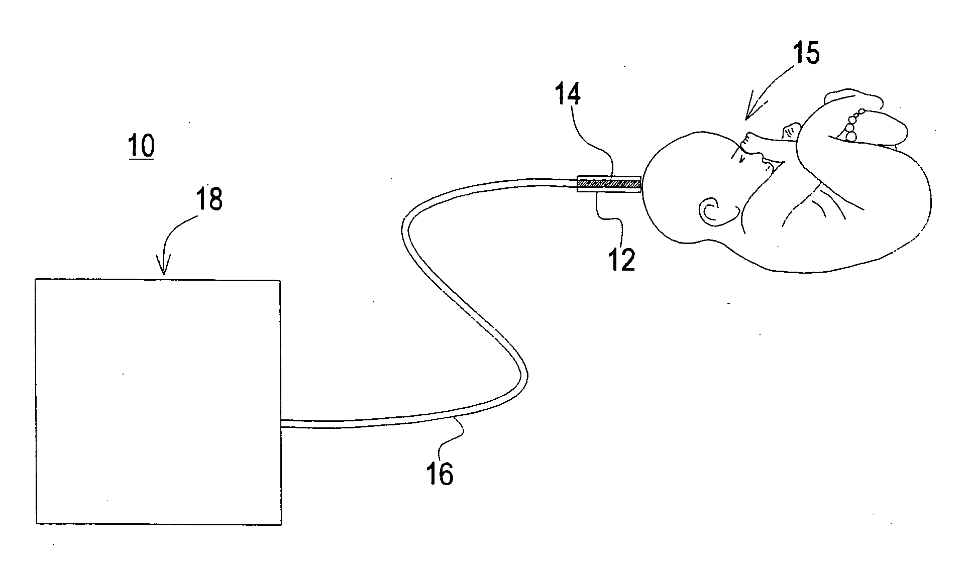 Fetal lactic acid monitor