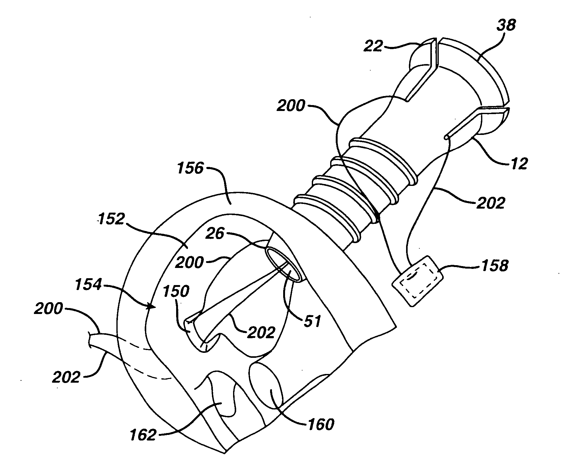 Method of delivering therapeutic implant