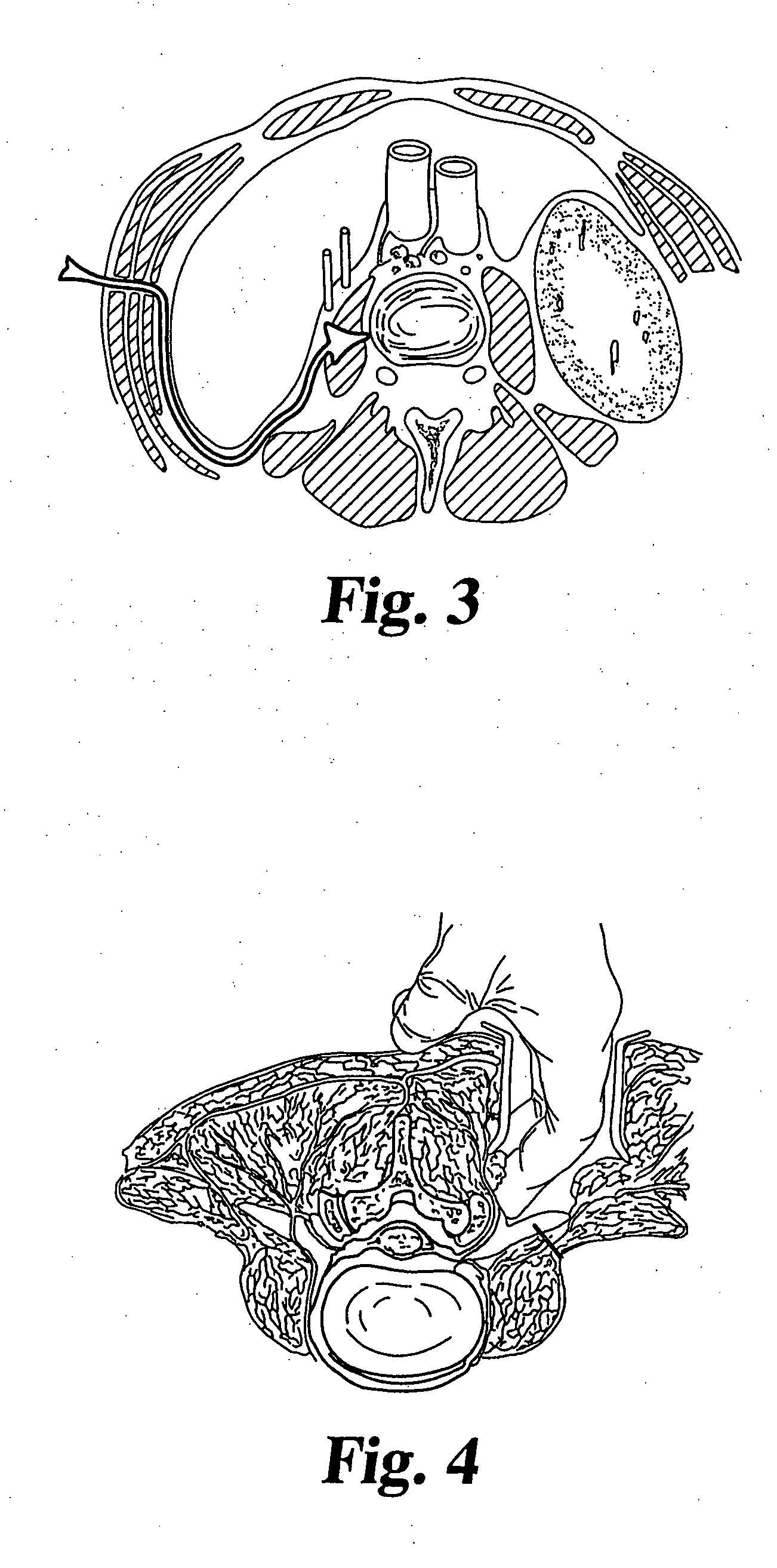 Methods for treating defects and injuries of an intervertebral disc