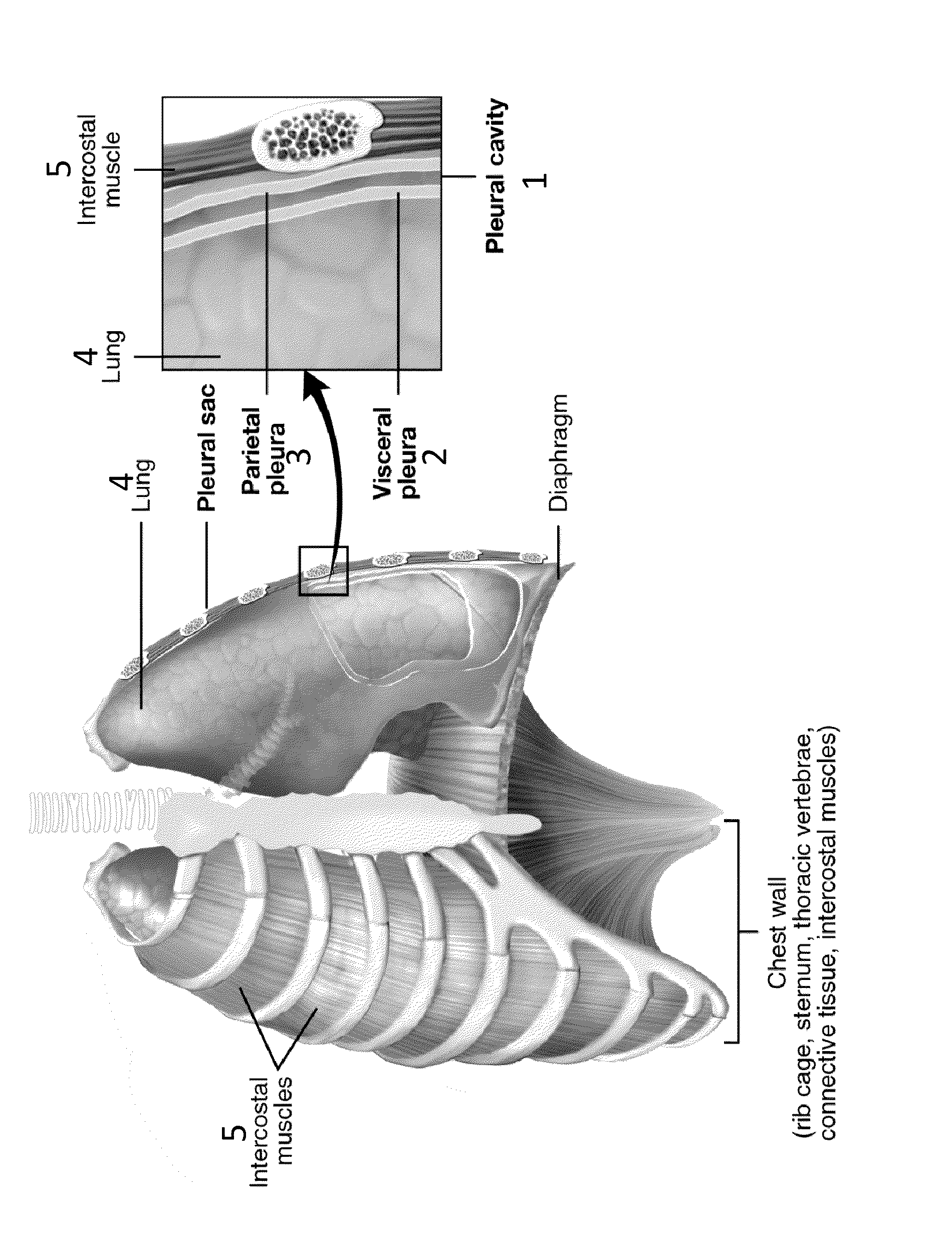Methods and Compositions for Administering an Active Agent to the Pleura of a Patient