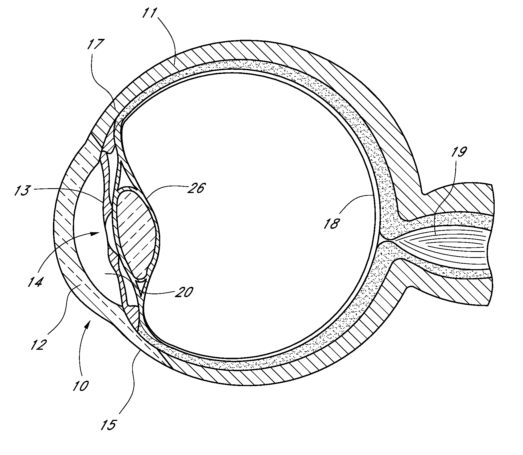 Method of monitoring intraocular pressure and treating an ocular disorder