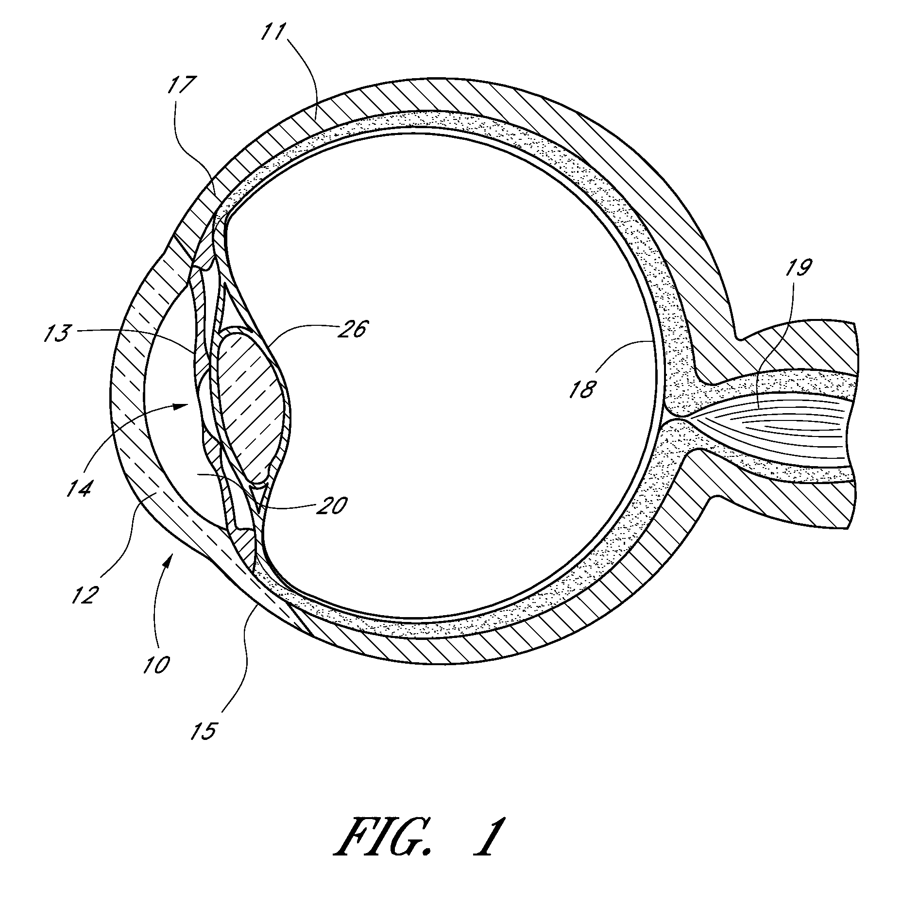 Method of monitoring intraocular pressure and treating an ocular disorder