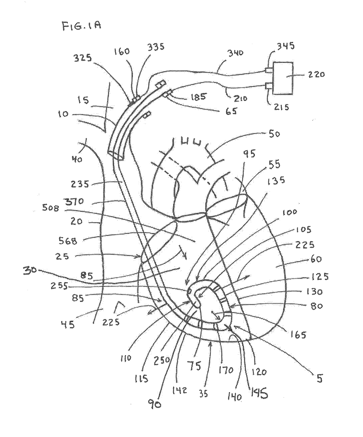 Temporary pacing lead