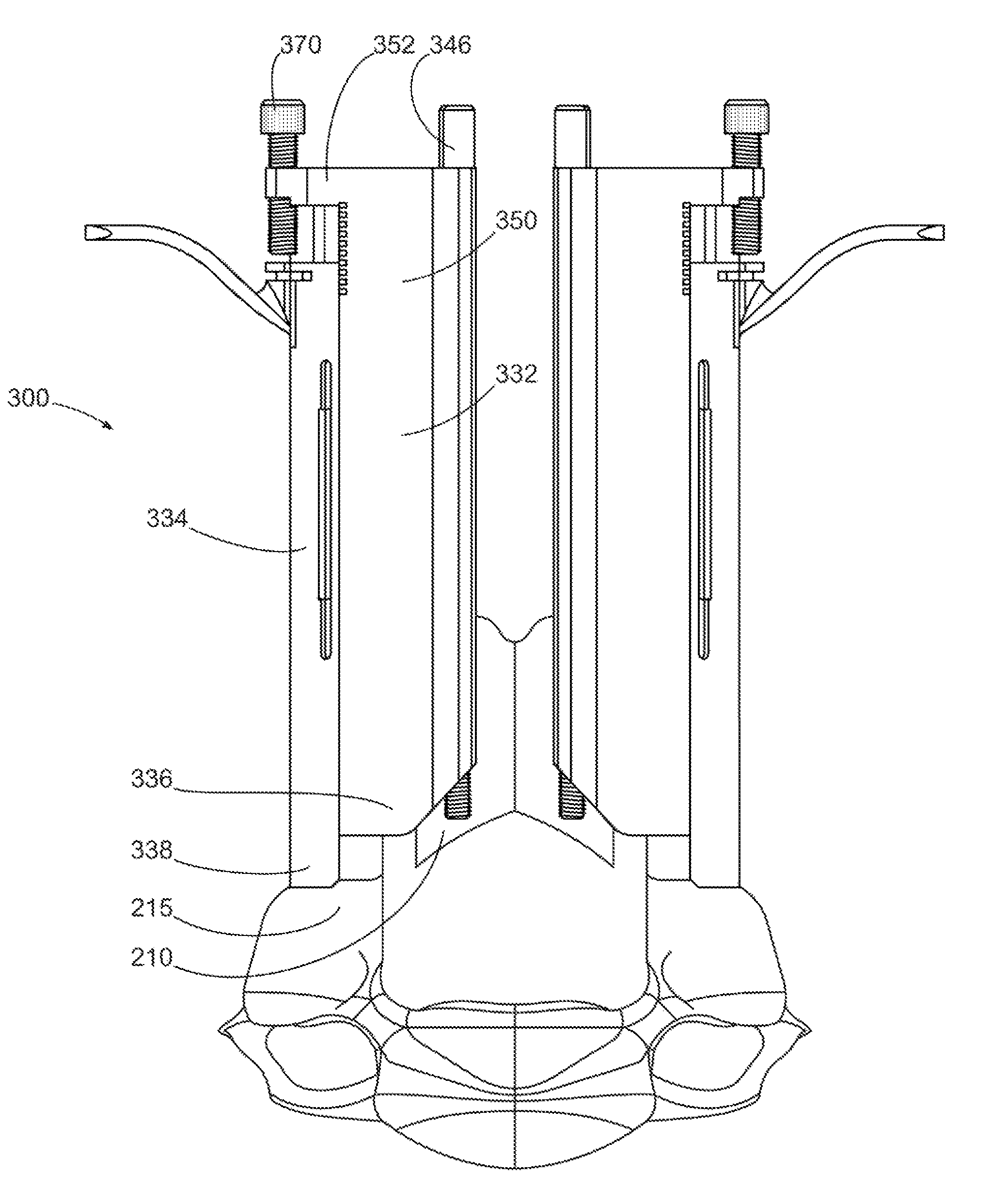 Laminoplasty system