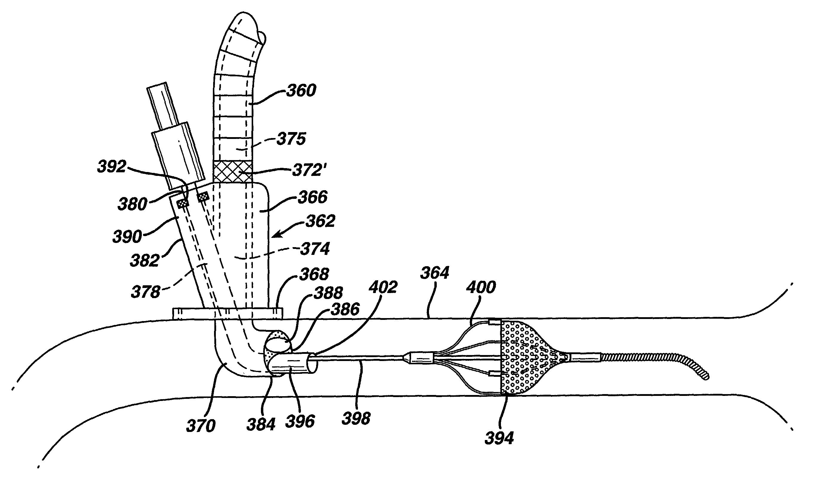 Vascular filter system for cardiopulmonary bypass