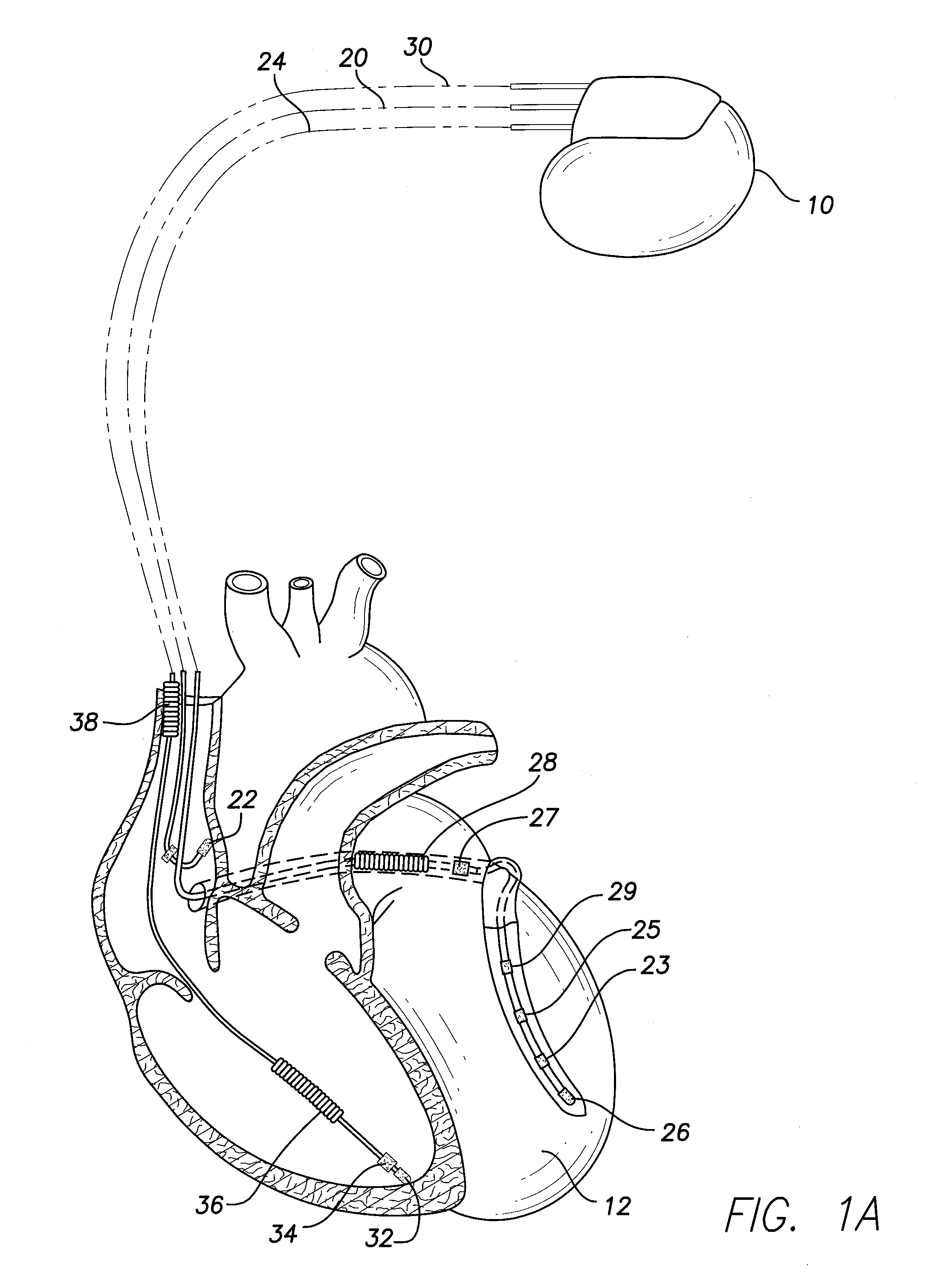 System and Method for ATP Treatment Utilizing Multi-Electrode Left Ventricular Lead