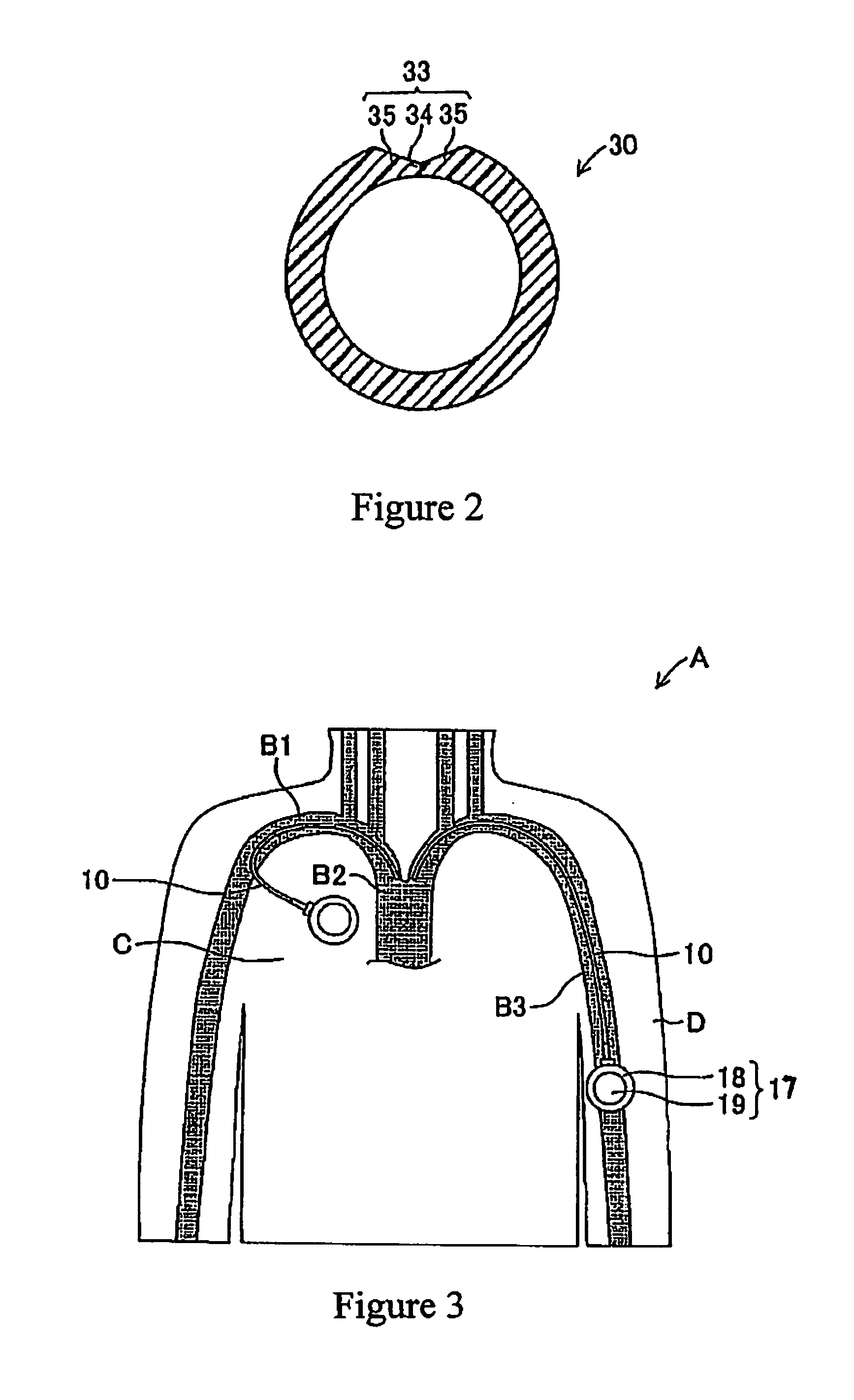 Catheter with valve
