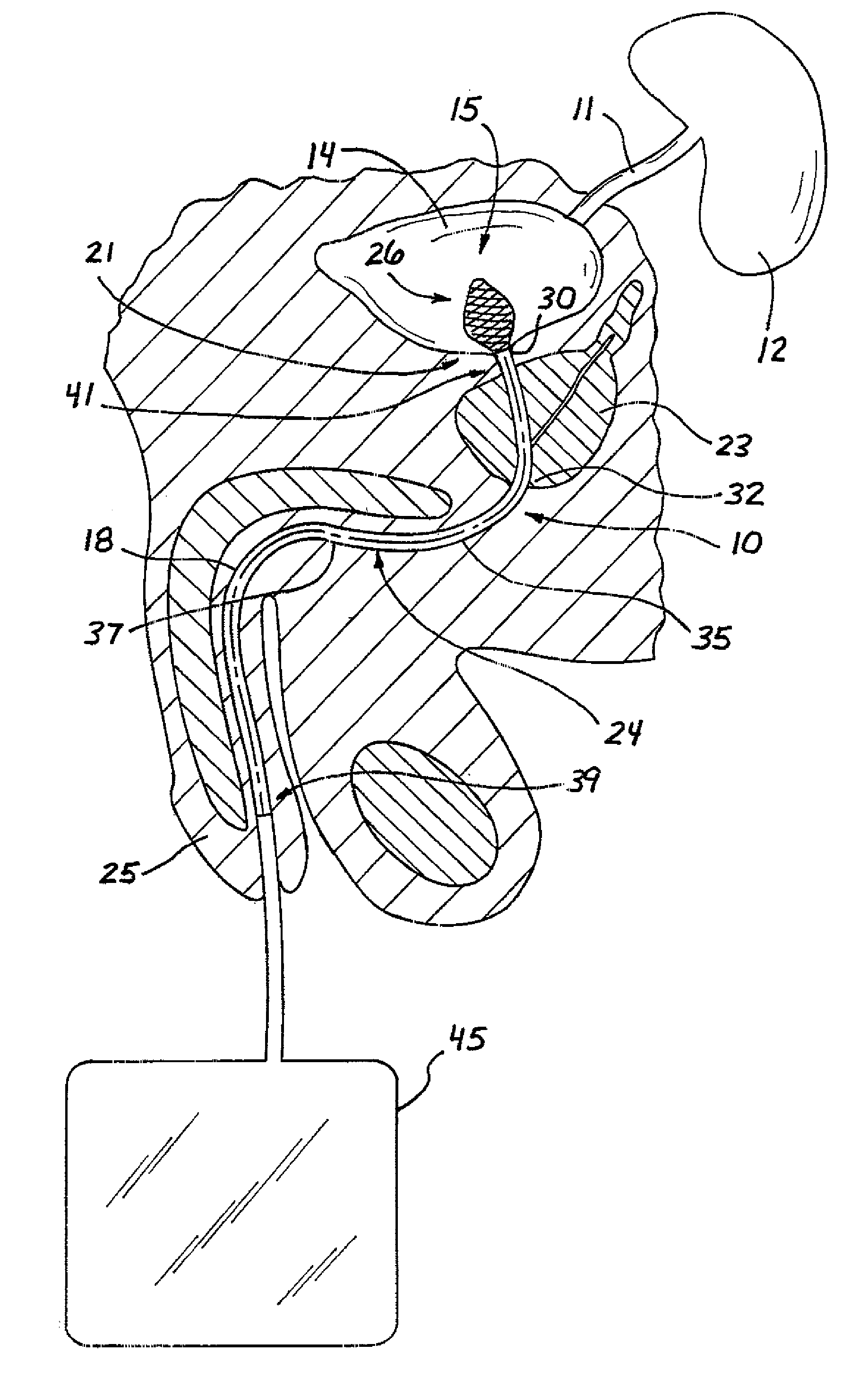 Drainage catheter having an expandable retention member