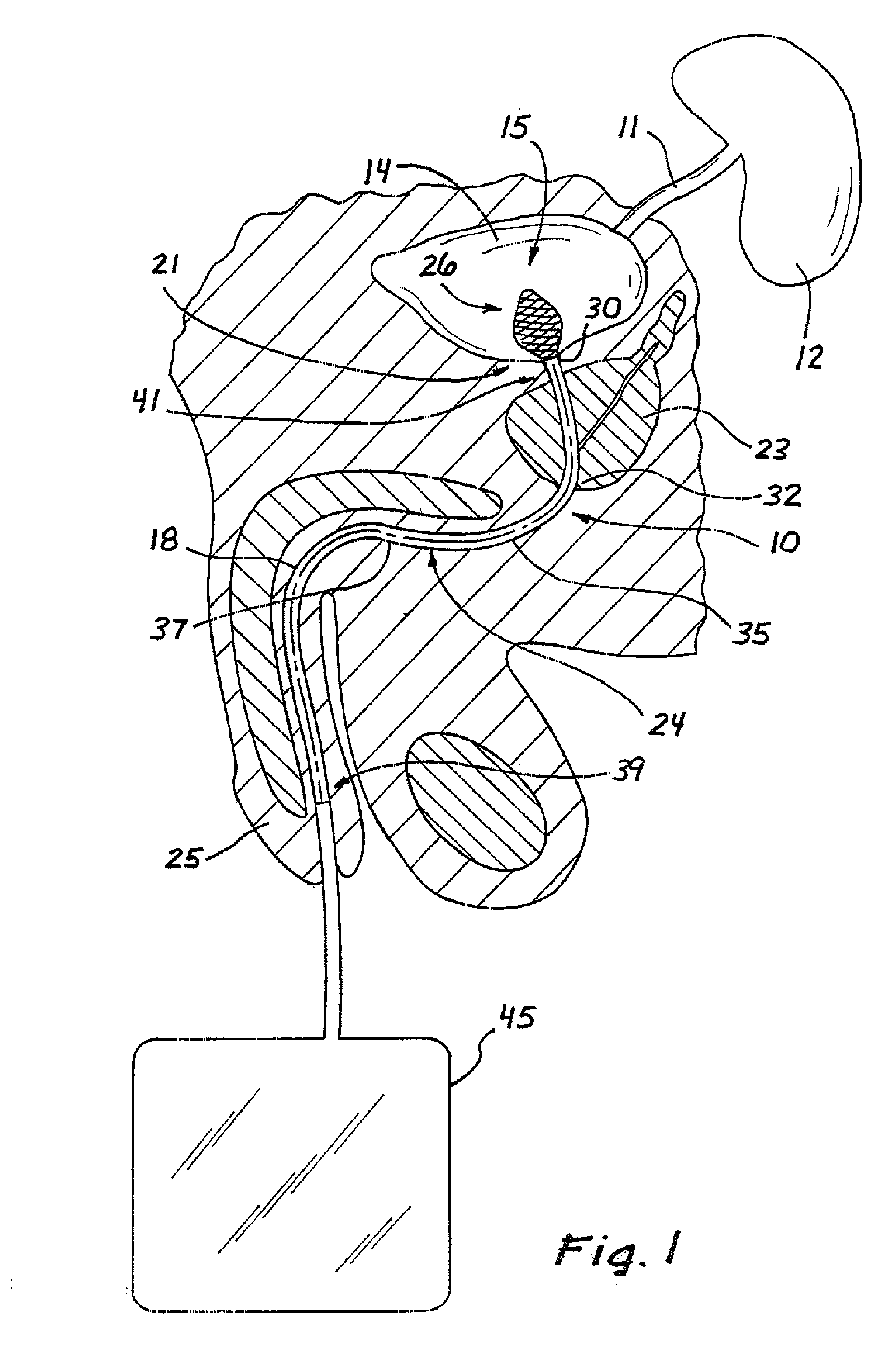 Drainage catheter having an expandable retention member