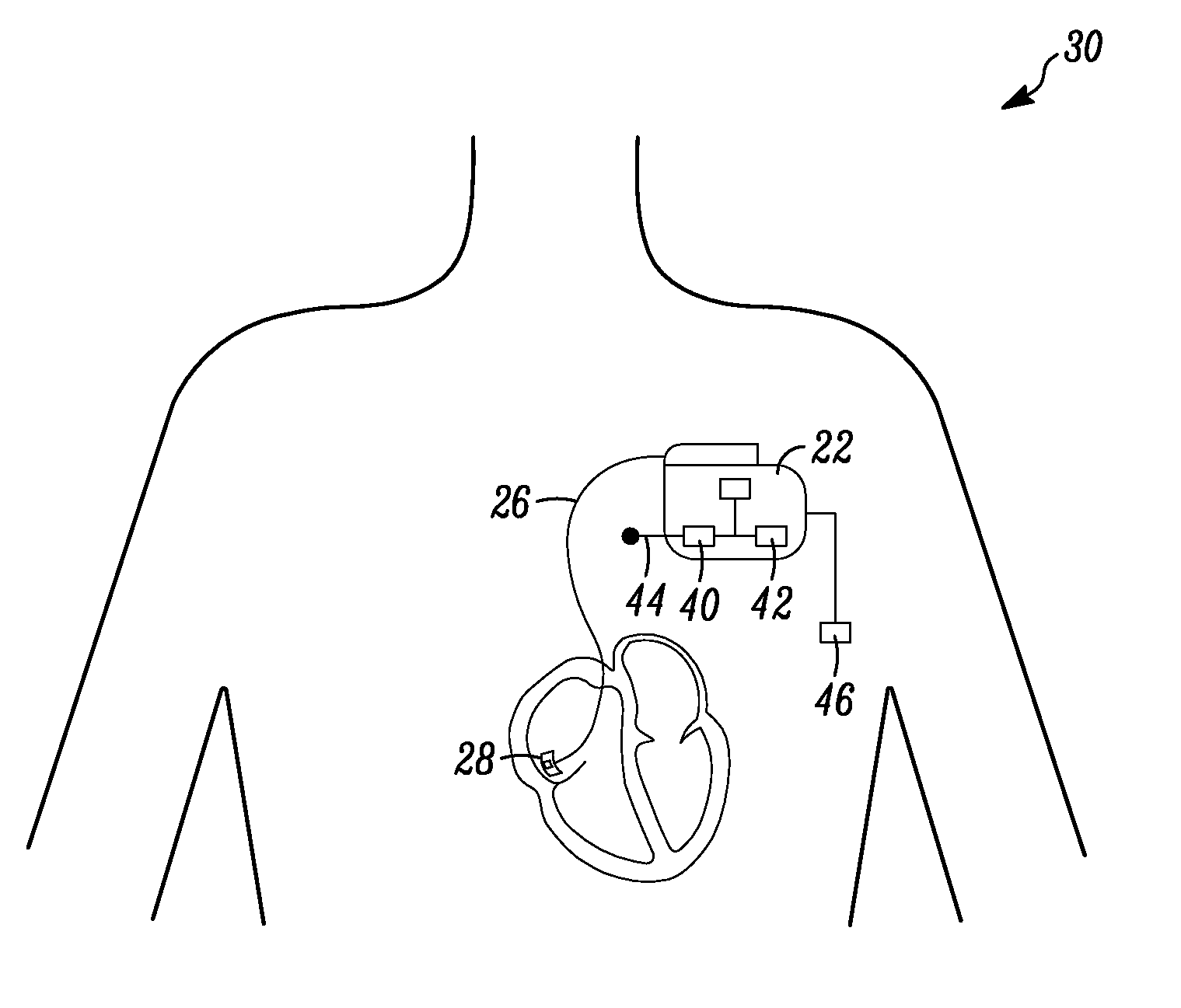 Glycemic control monitoring using implantable medical device