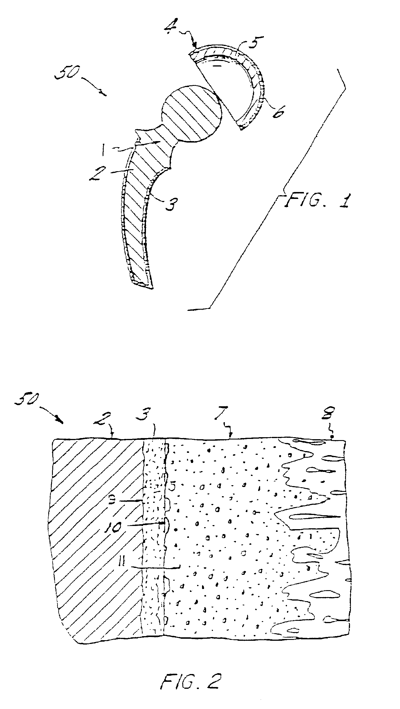Bone connective prosthesis and method of forming same