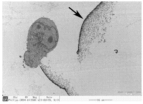 Microencapsulated human pancreatic carcinoma cells, and preparation method and application thereof