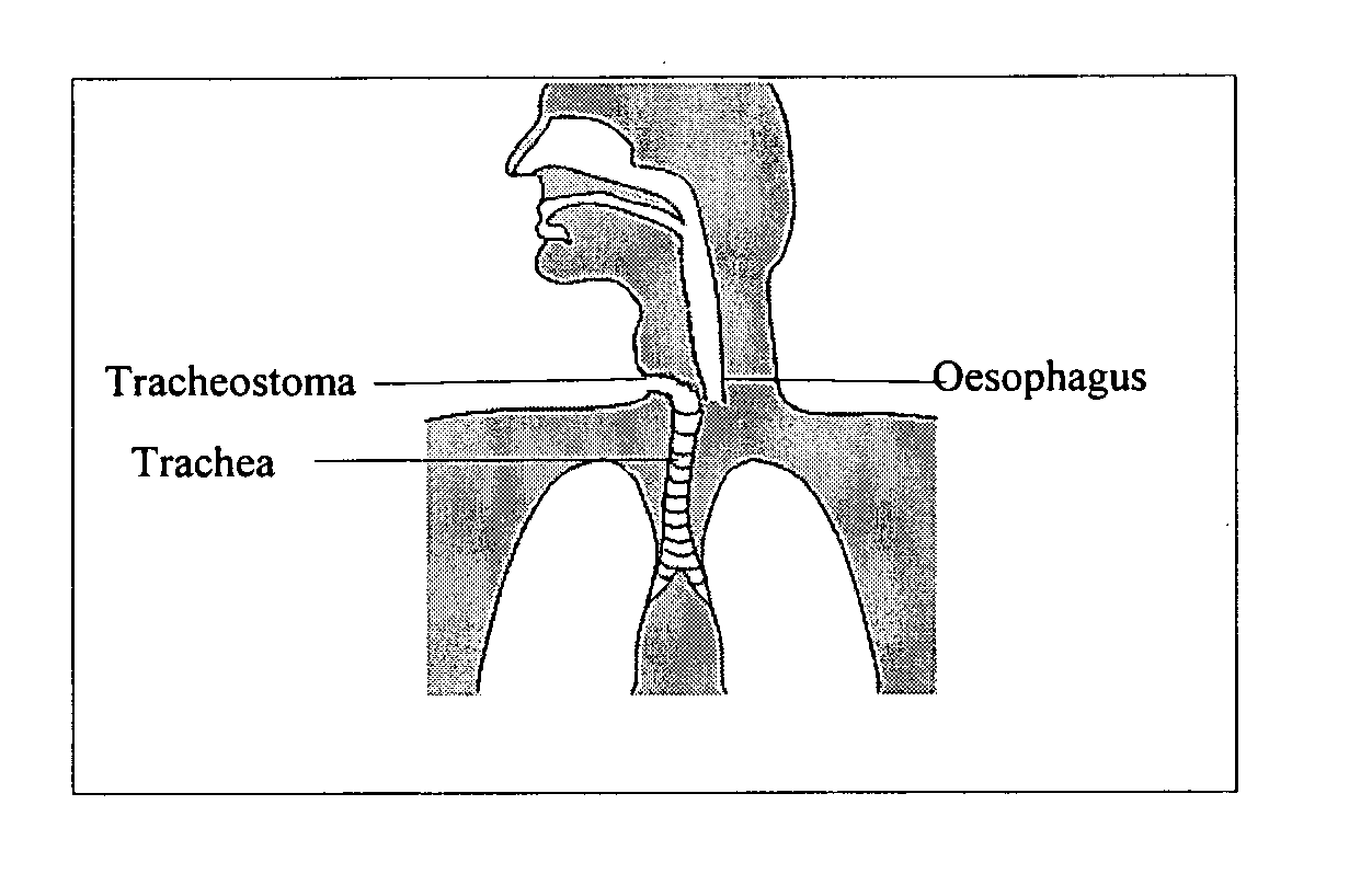 Artificial Larynx