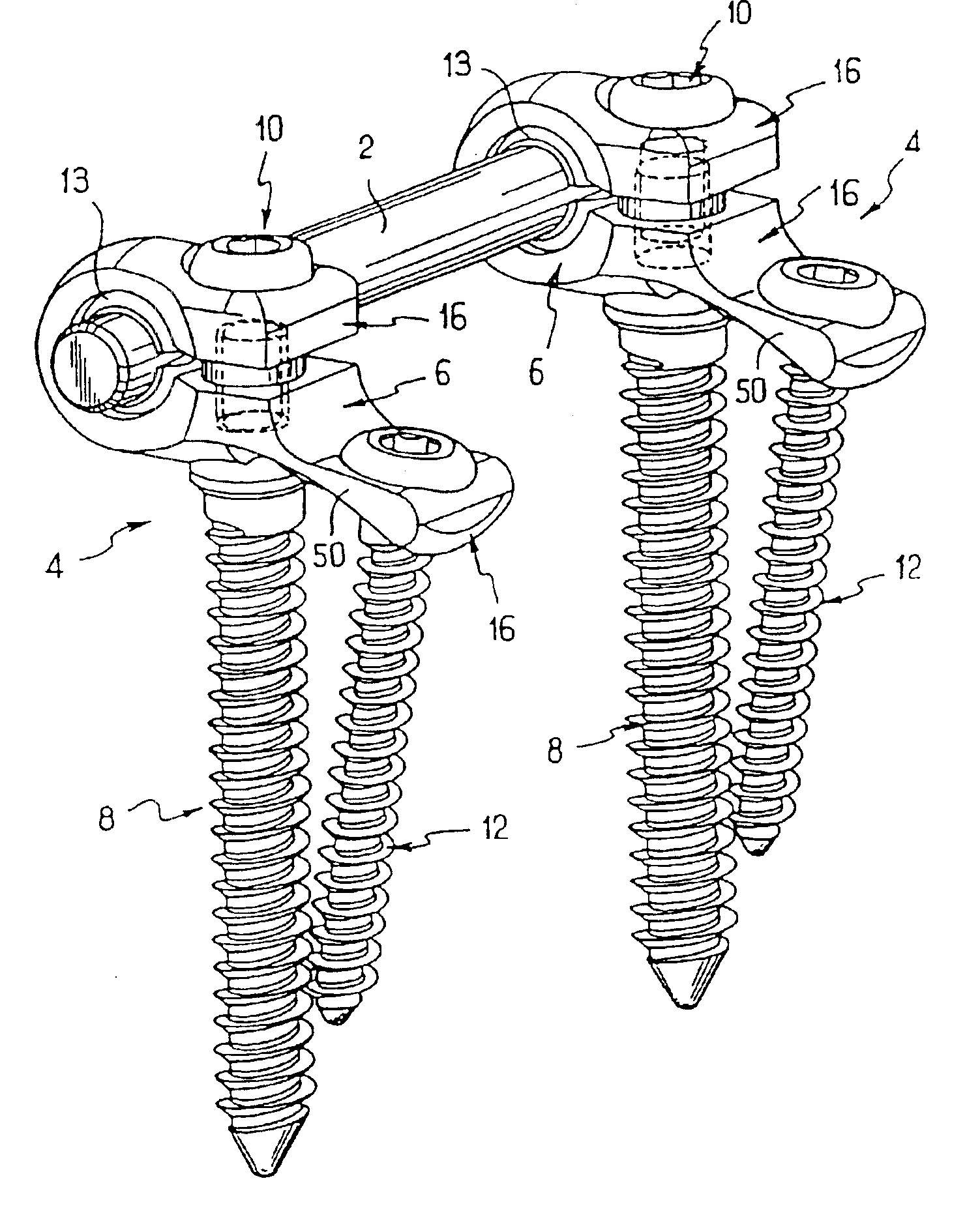 Backbone osteosynthesis system with clamping means in particular for anterior fixing