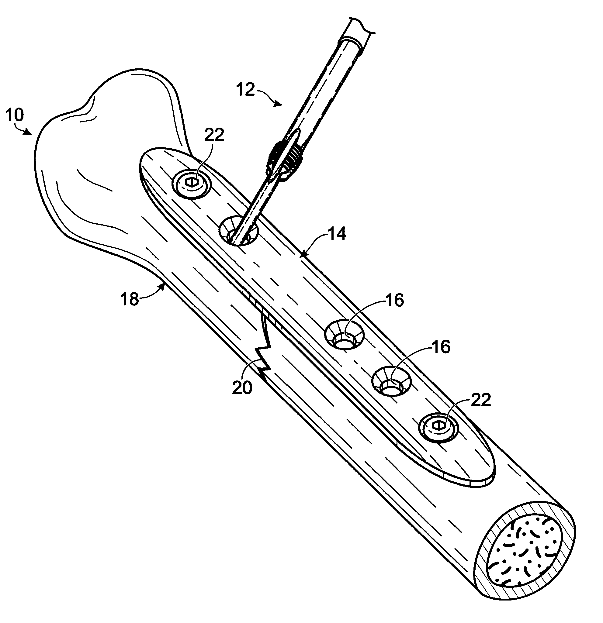 Bone plates with intraoperatively tapped apertures