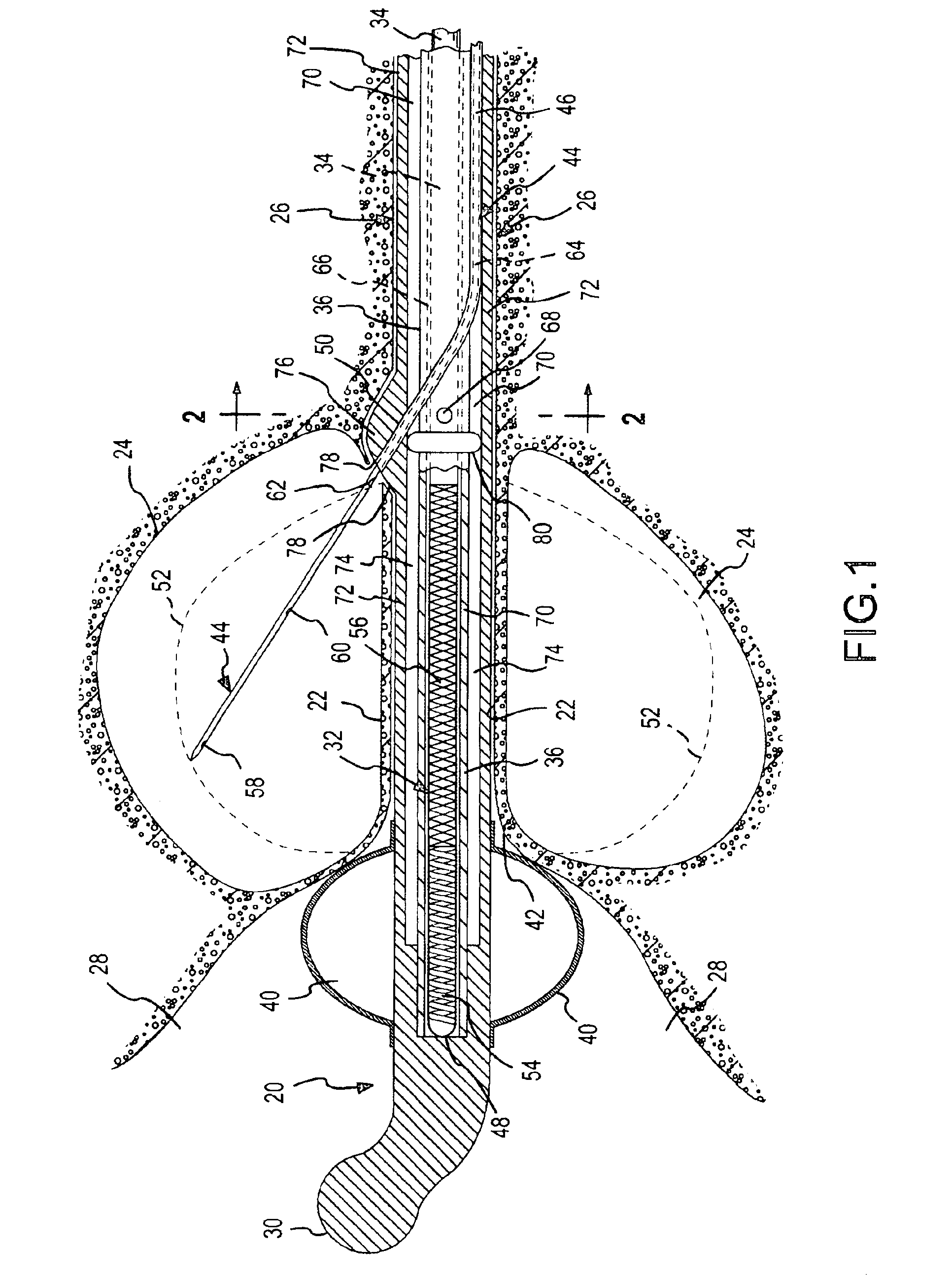 Thermotherapy catheter and method of prostate thermotherapy with improved guide and heat confinement