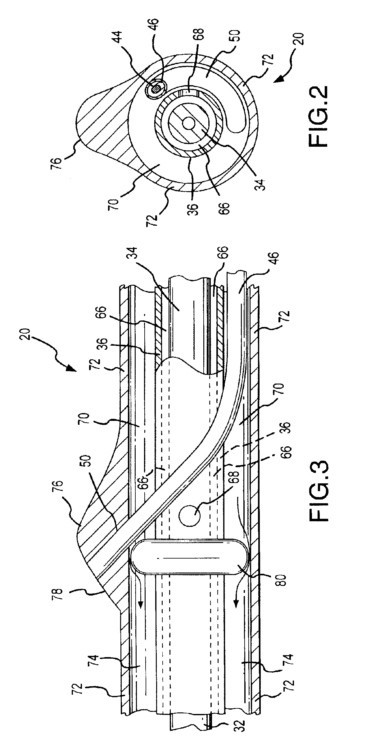 Thermotherapy catheter and method of prostate thermotherapy with improved guide and heat confinement