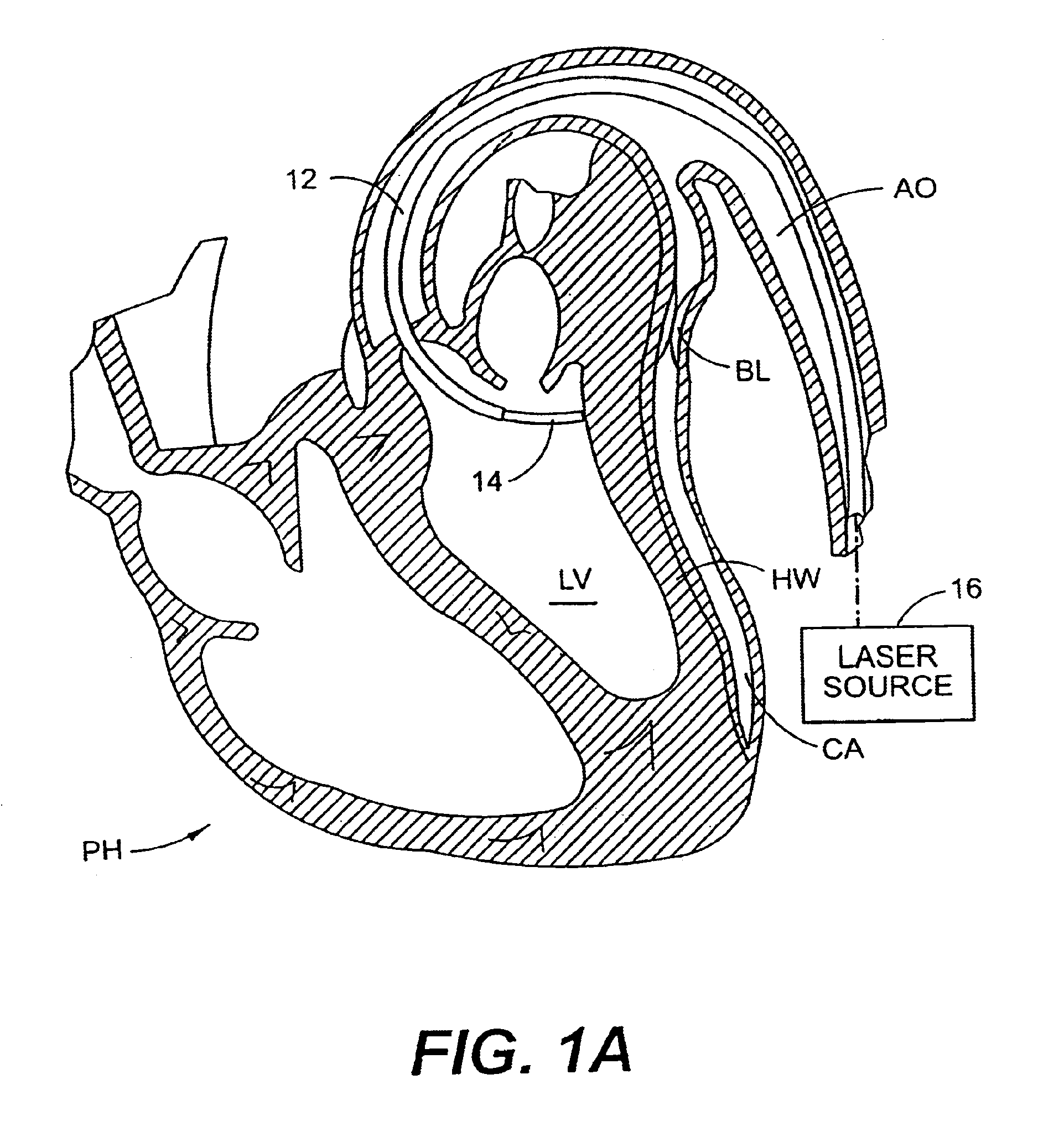 Left ventricular conduits to coronary arteries and methods for coronary bypass