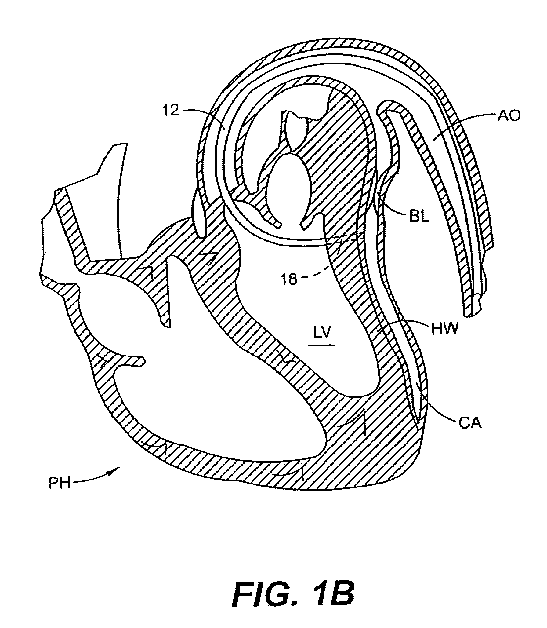 Left ventricular conduits to coronary arteries and methods for coronary bypass