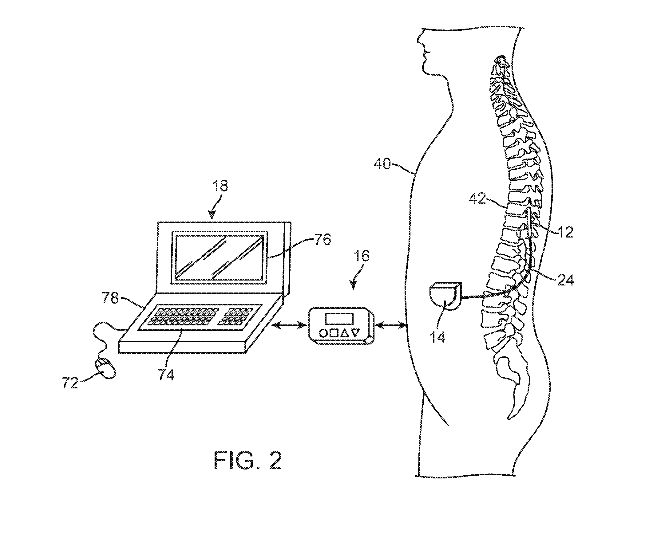 Systems and methods for programming a neuromodulation system