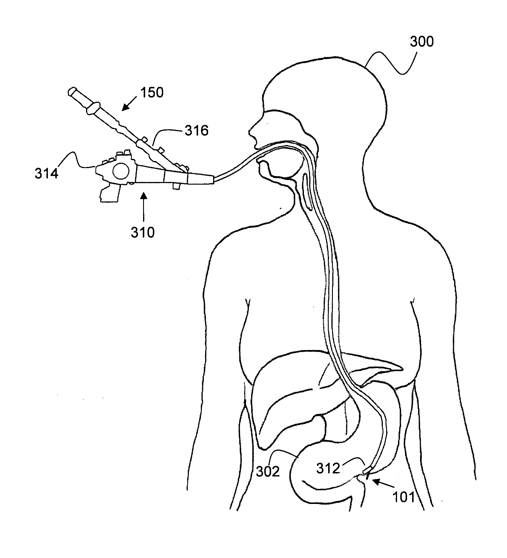 Method and system for implant delivery