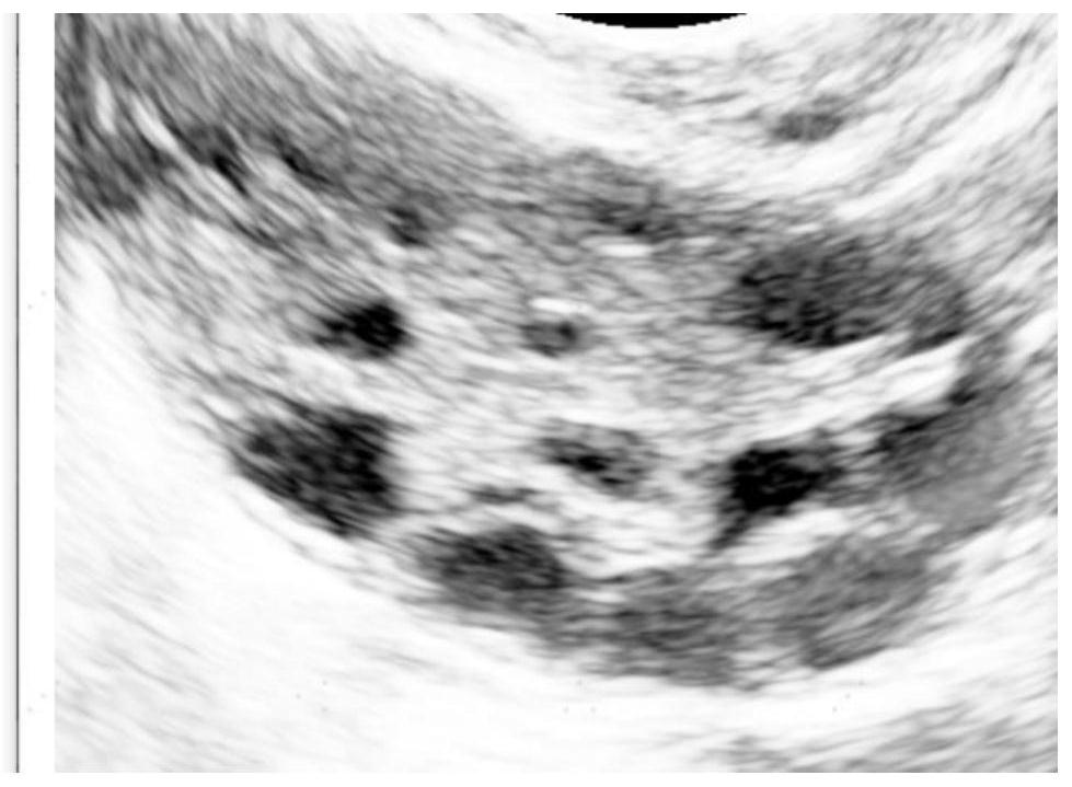 Follicle information extraction method based on ultrasonic image and related device