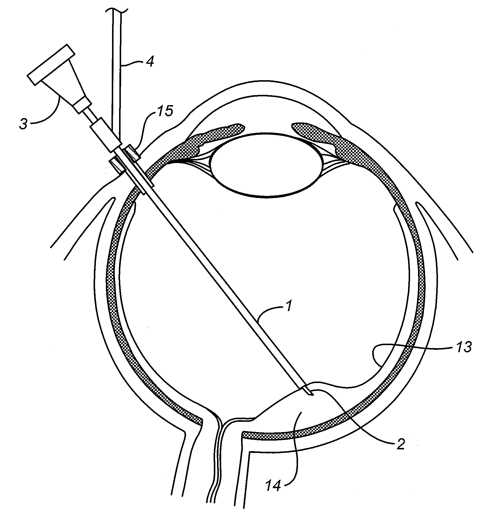 Subretinal access device