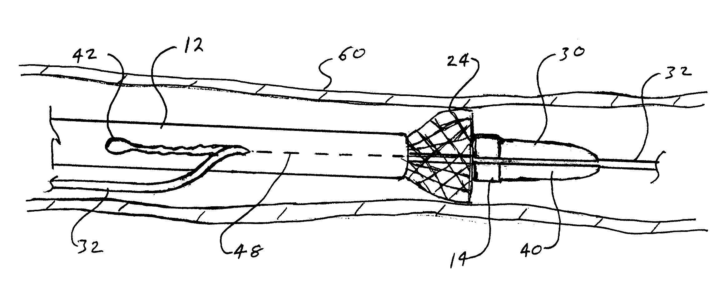 Short wire stent delivery system with splittable outer sheath