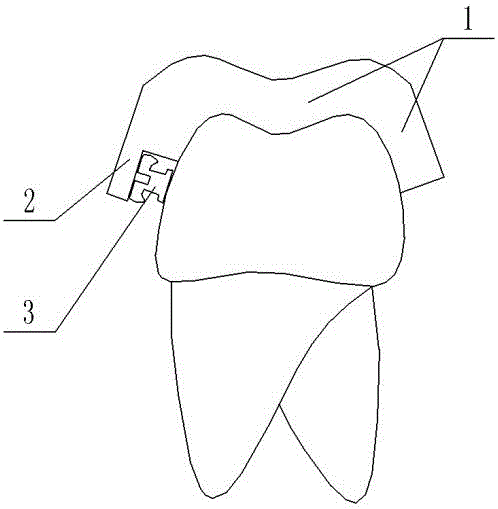 Split type guide plate for accurately positioning orthodontic bracket