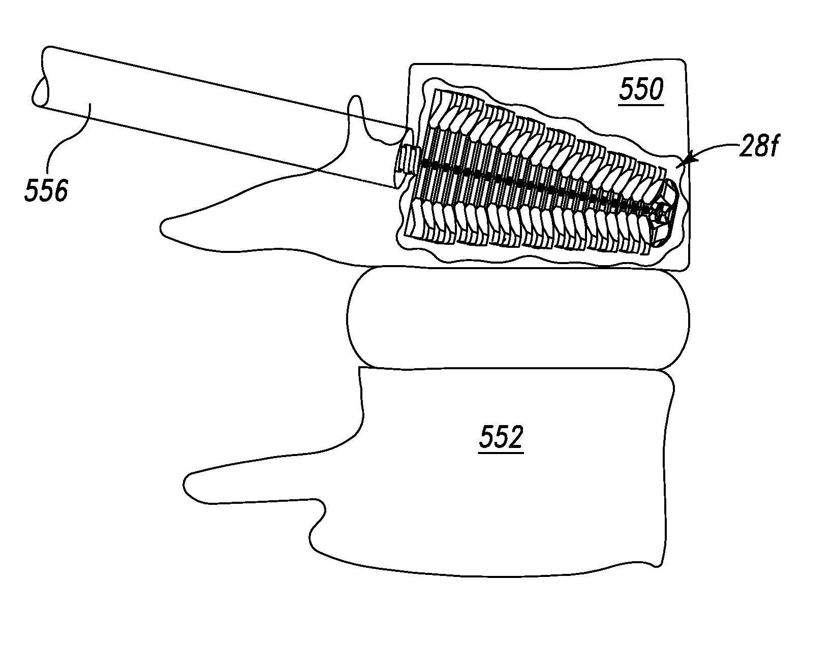 Expandable spinal interbody and intravertebral body devices