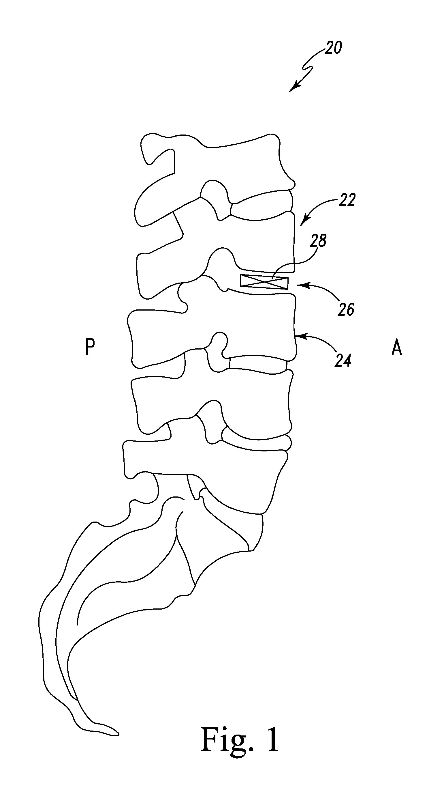 Expandable spinal interbody and intravertebral body devices