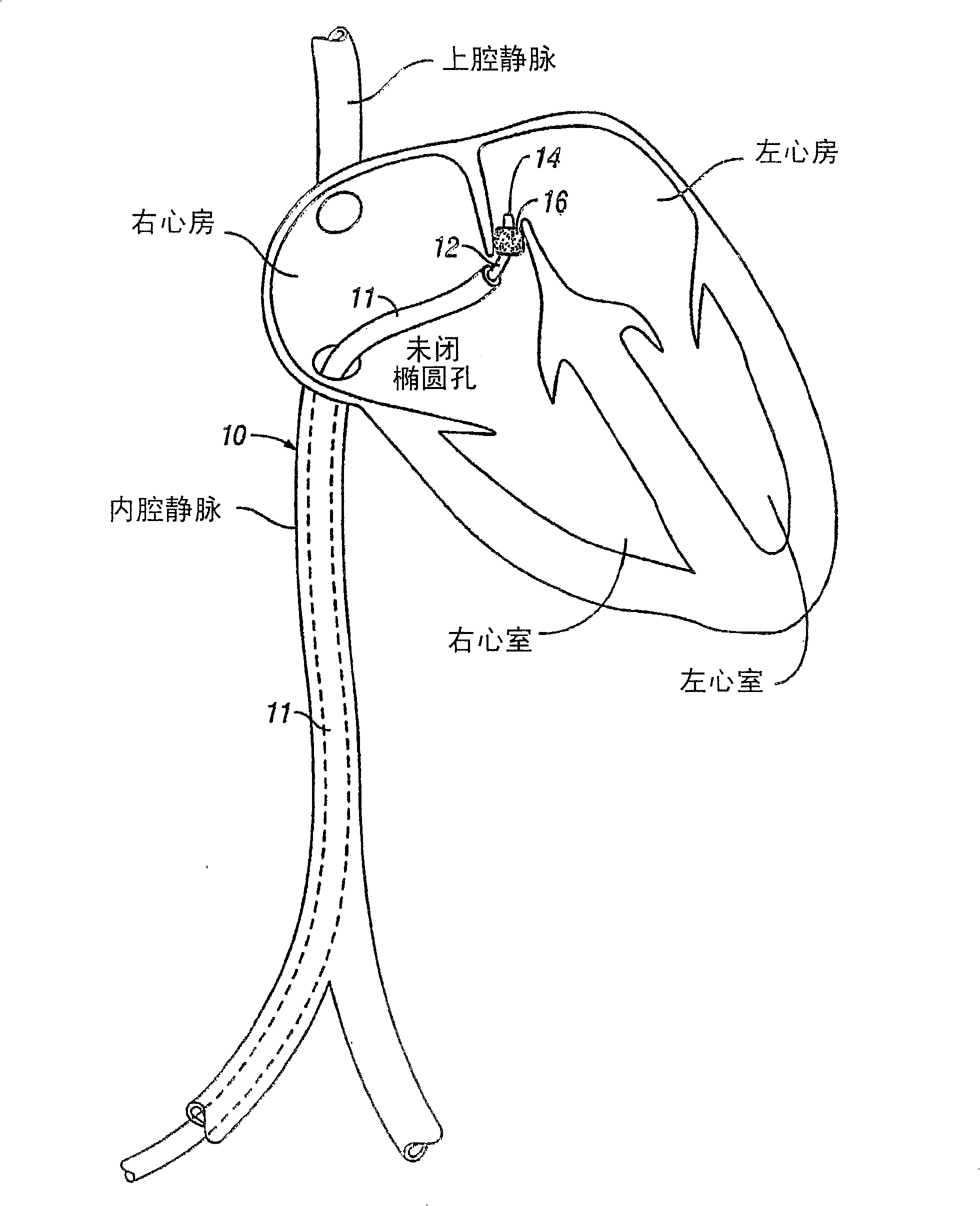 Methods and apparatus for treatment of patent foramen ovale