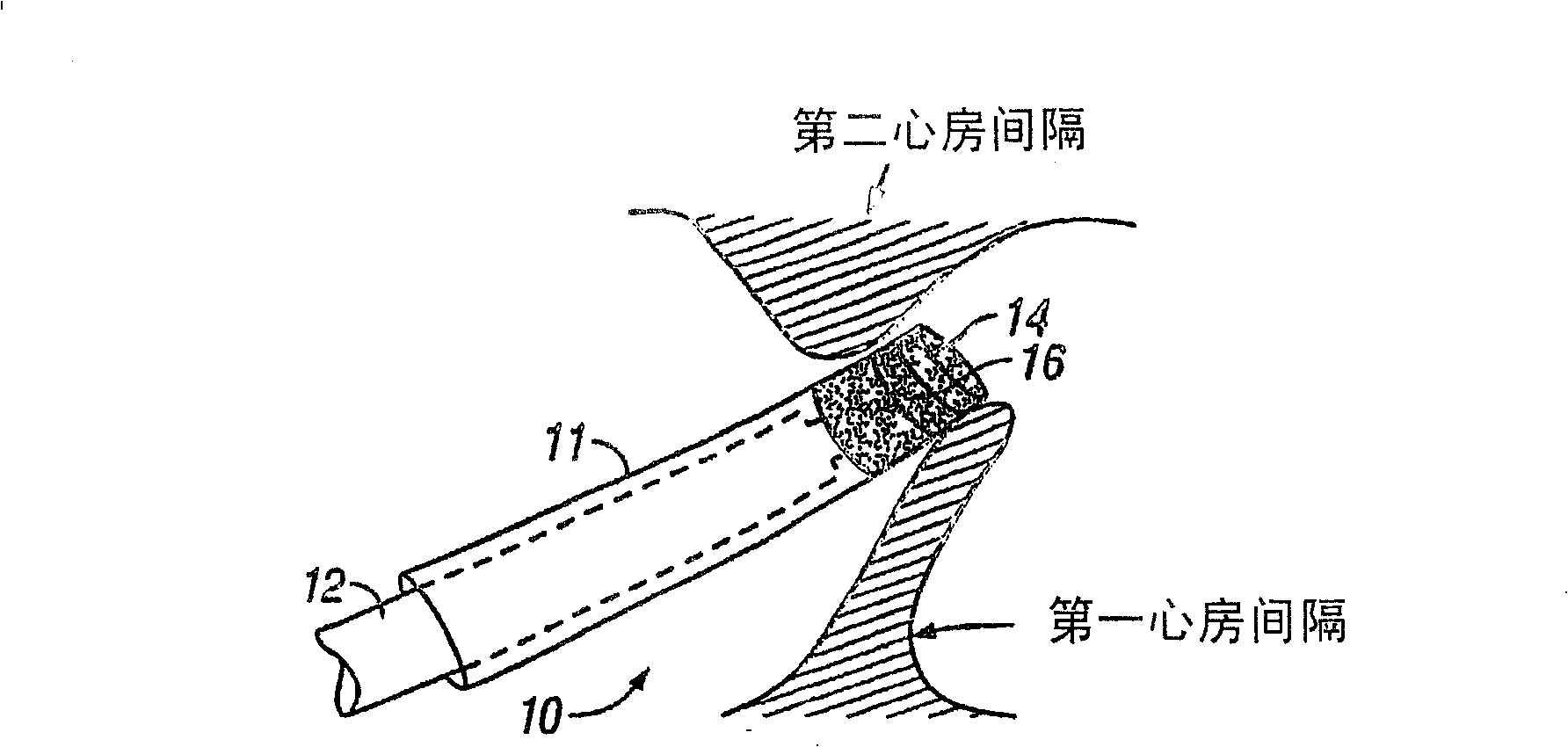 Methods and apparatus for treatment of patent foramen ovale