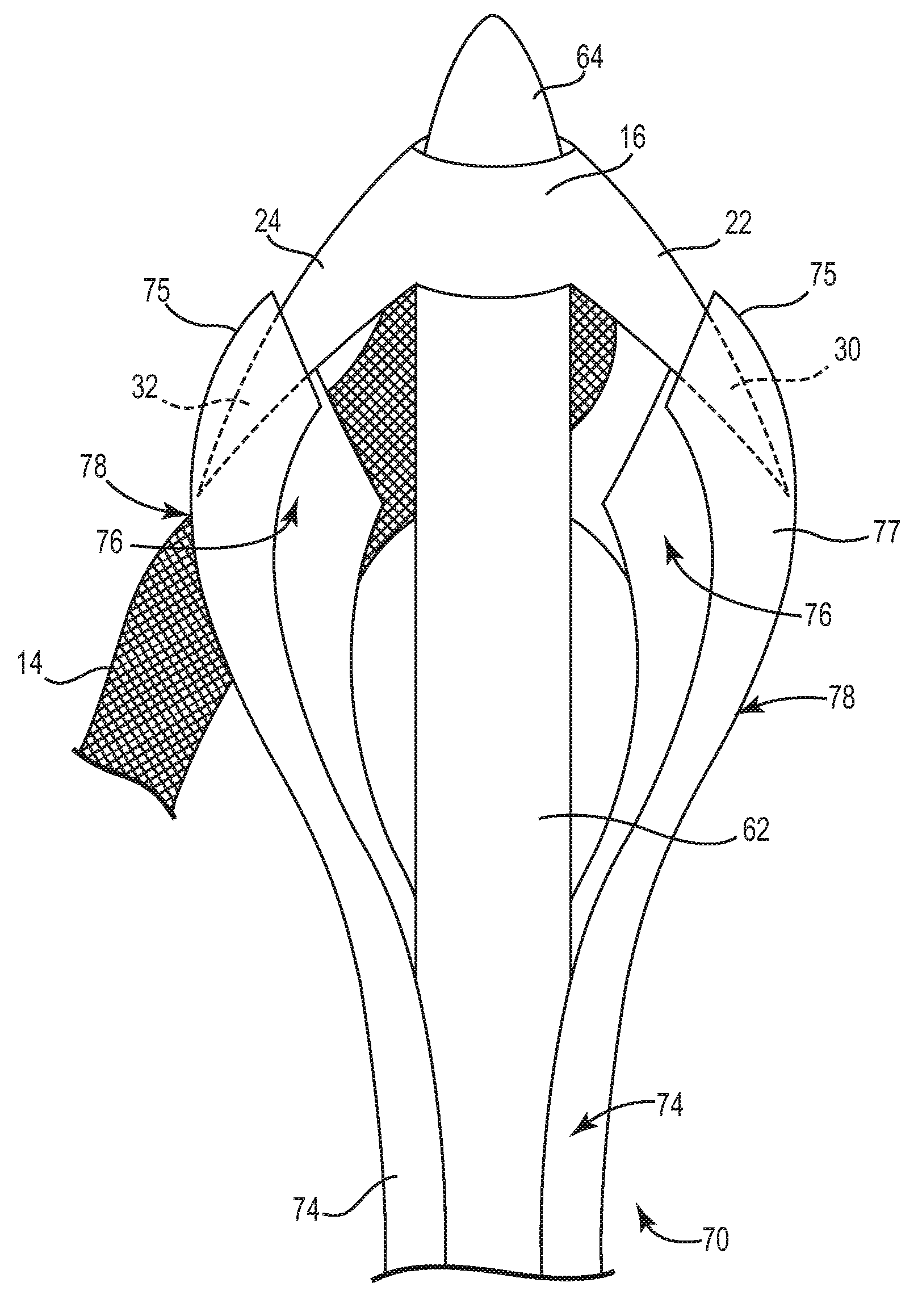 Pelvic implant and delivery system
