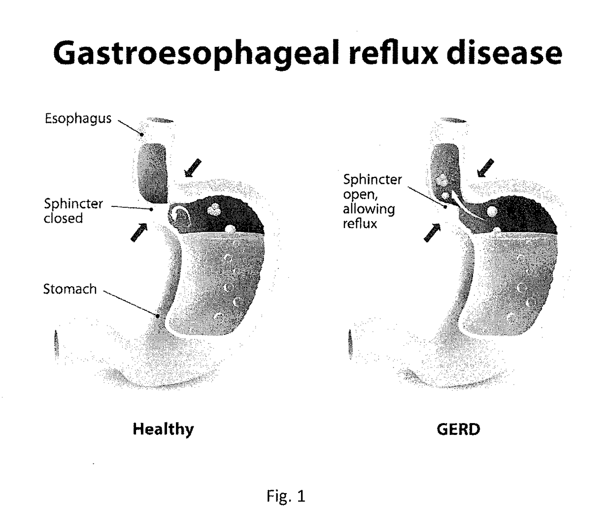 Method and System for Treating Gastro-Esophageal Reflux Disease (GERD)