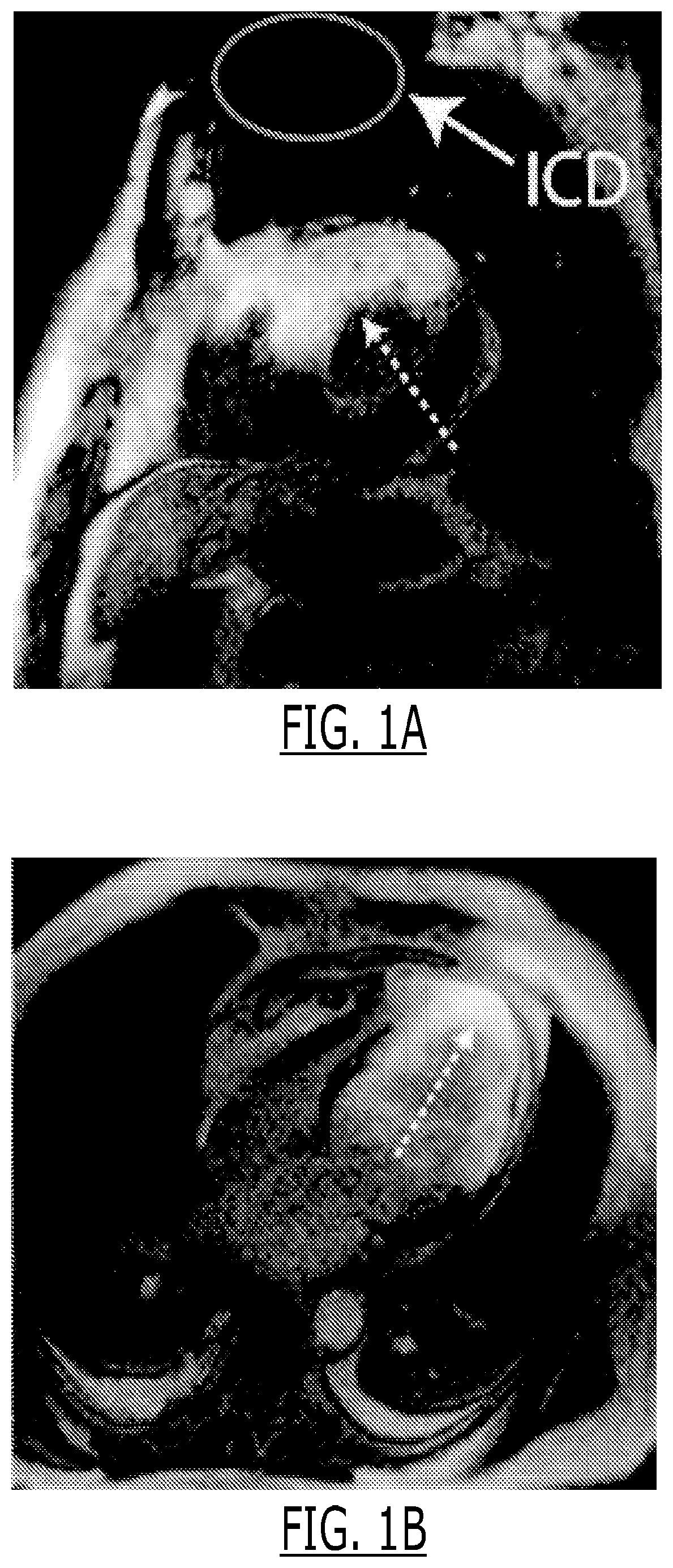 Cardiac late gadolinium enhancement MRI for patients with implanted cardiac devices
