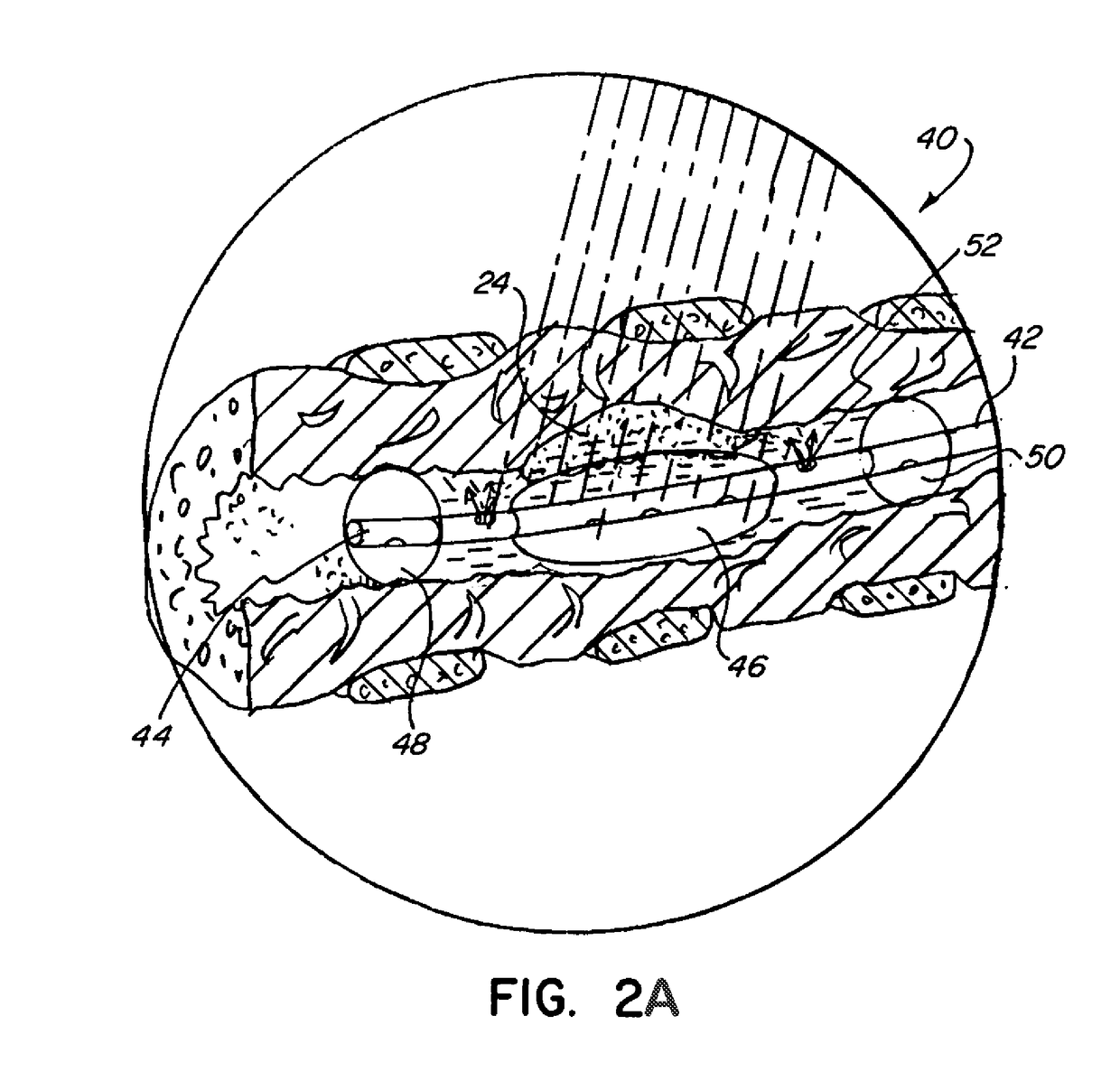 Photodynamic therapy for tumors with localized delivery